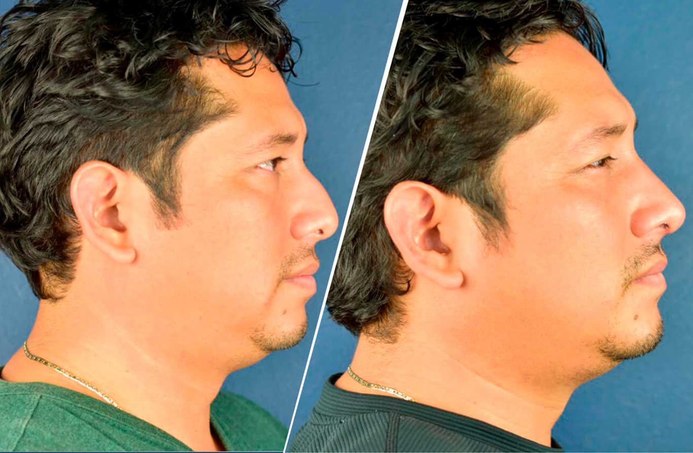 Rinoplastia-Ultrasónica-Rhinoplasty-HOMBRE