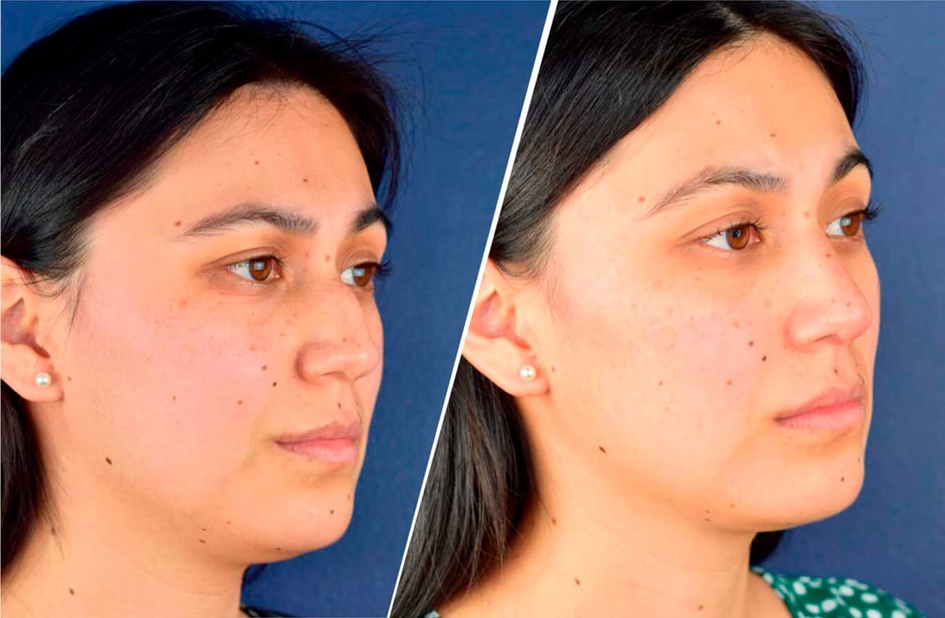 Rinoplastia-Ultrasónica-Rhinoplasty-MUJER