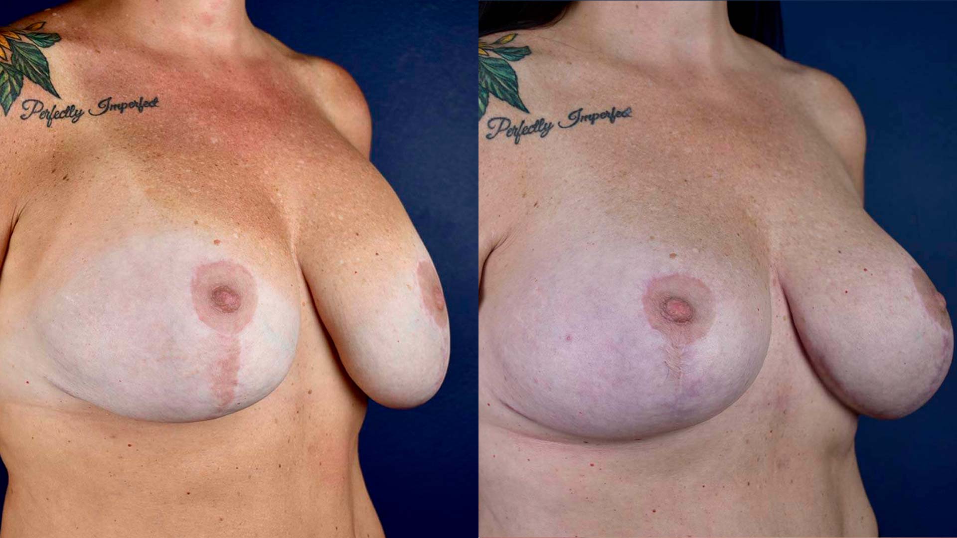 dr-valdez-breast-lift-eight