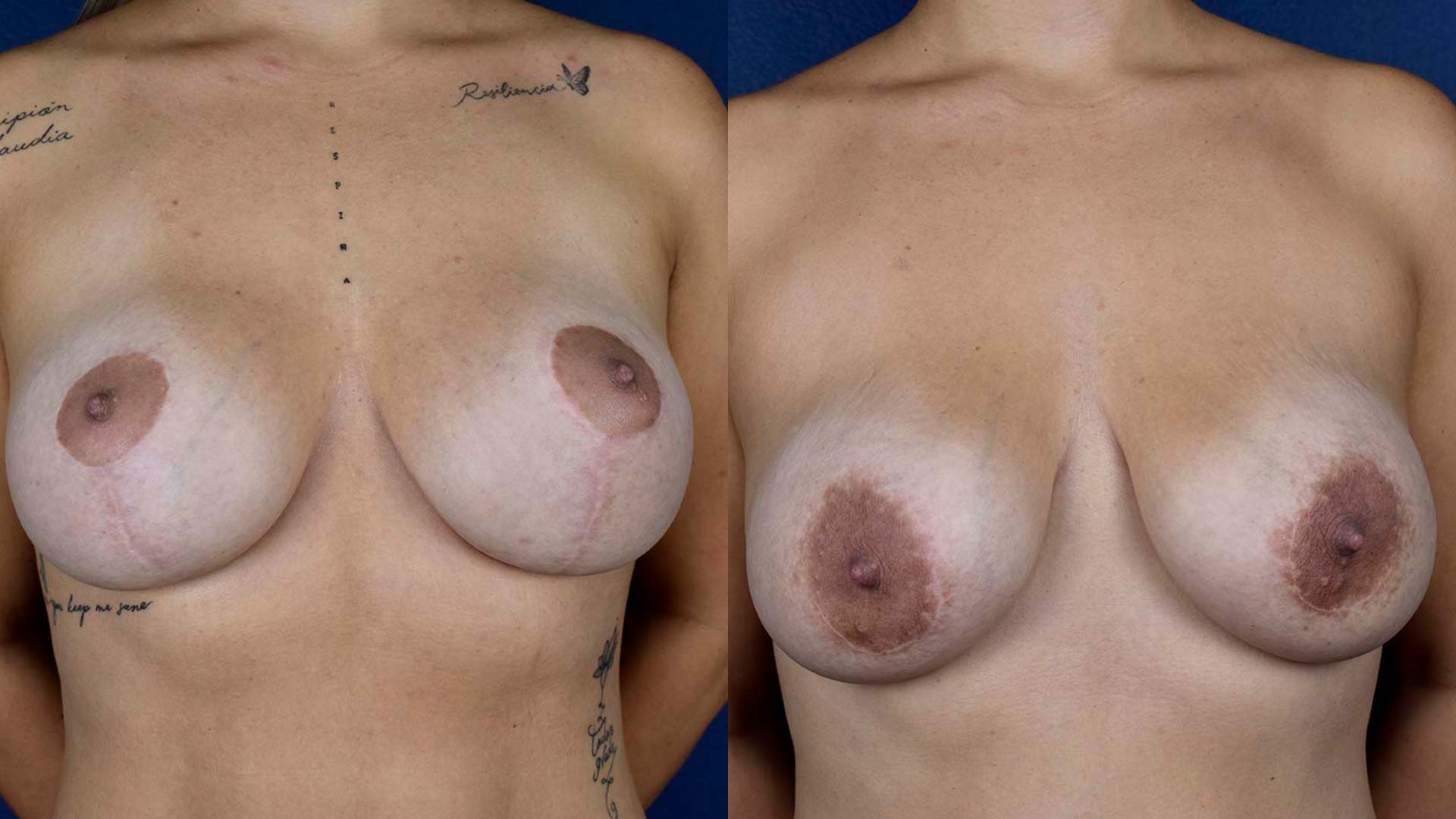 dr-valdez-breast-lift-nine