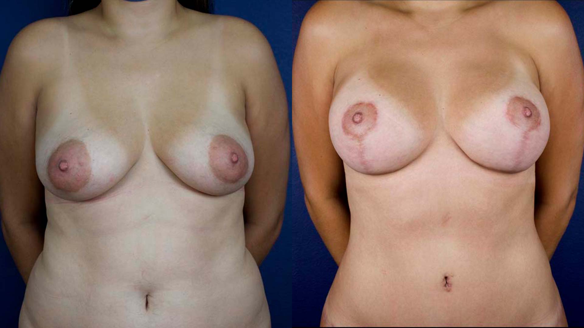 dr-valdez-breast-lift-one