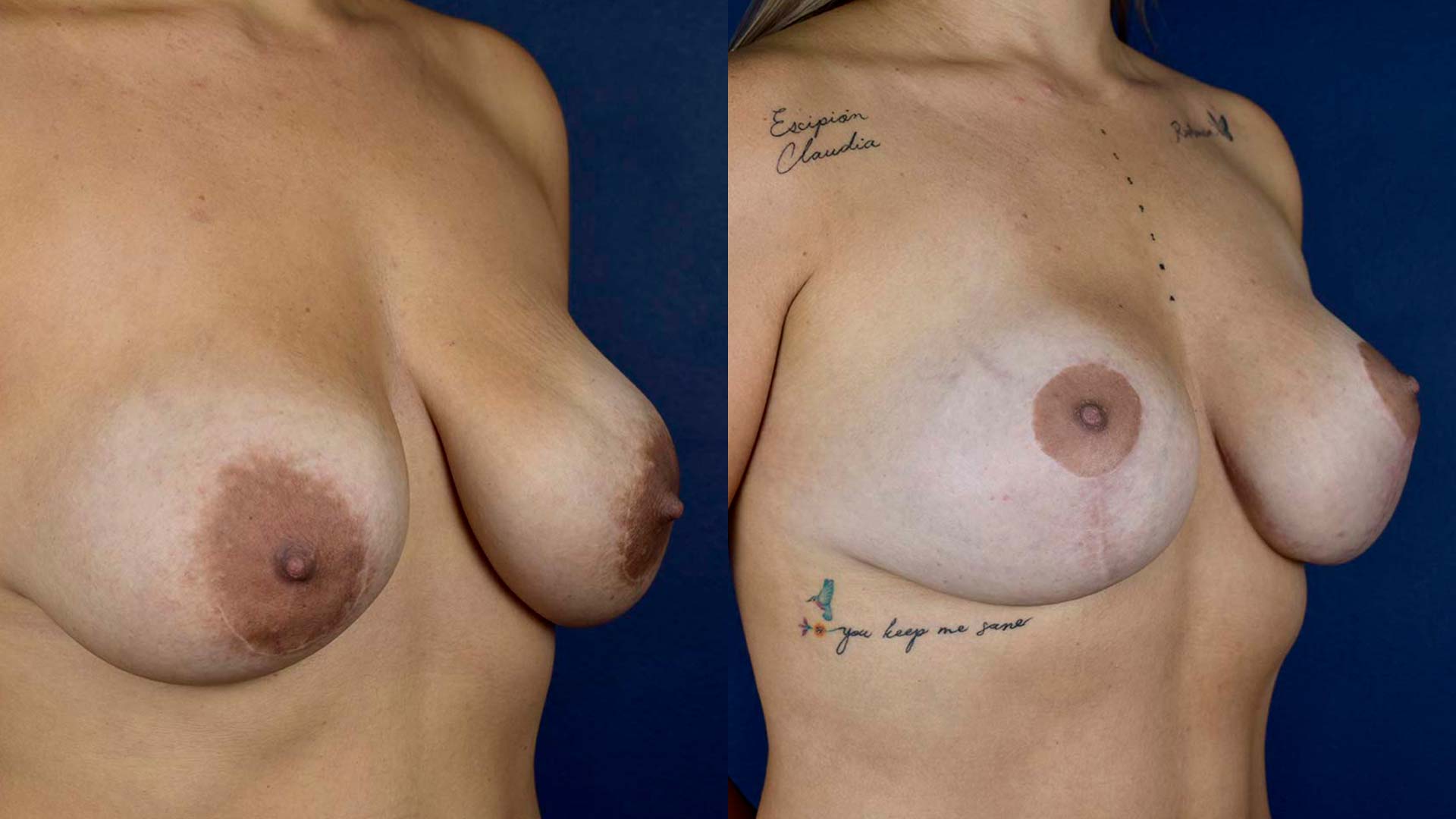 dr-valdez-breast-lift-ten