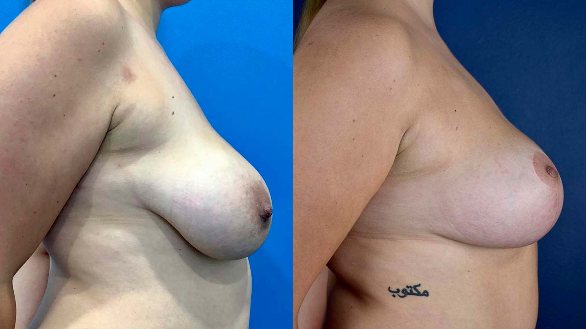 dr-valdez-breast-lift-twelve