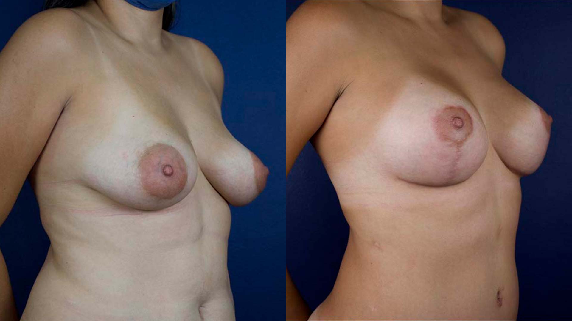 dr-valdez-breast-lift-two