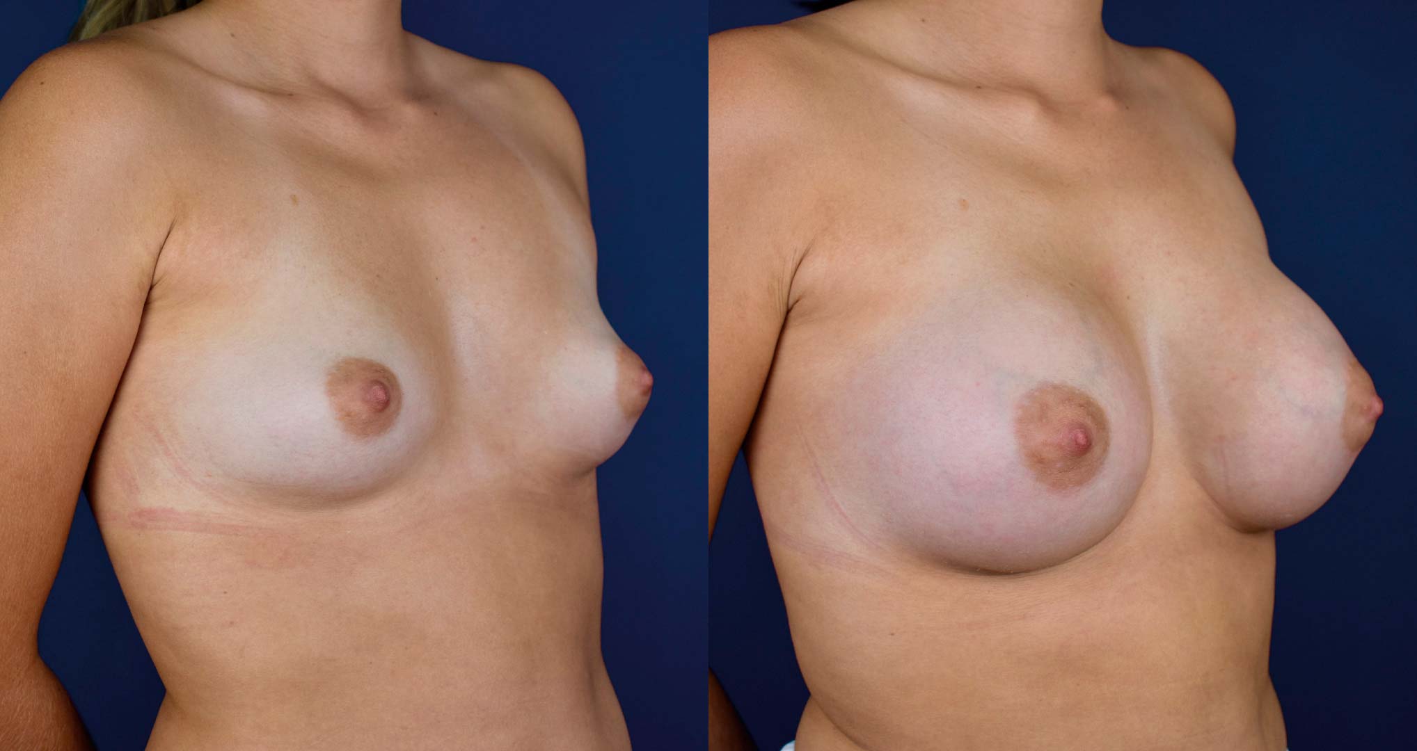 dr-valdez-breast-augmentation-_eleven