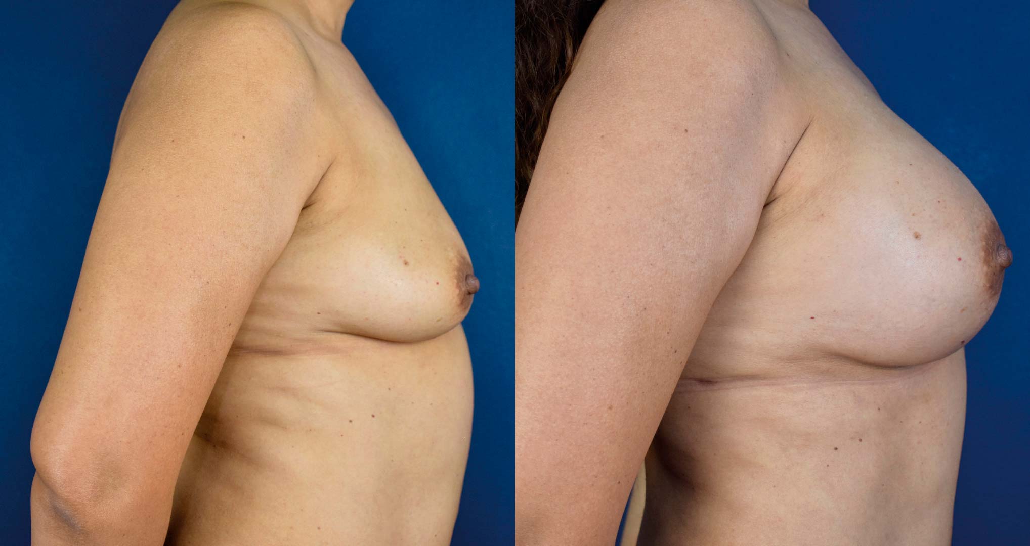 dr-valdez-breast-augmentation-_fifteen