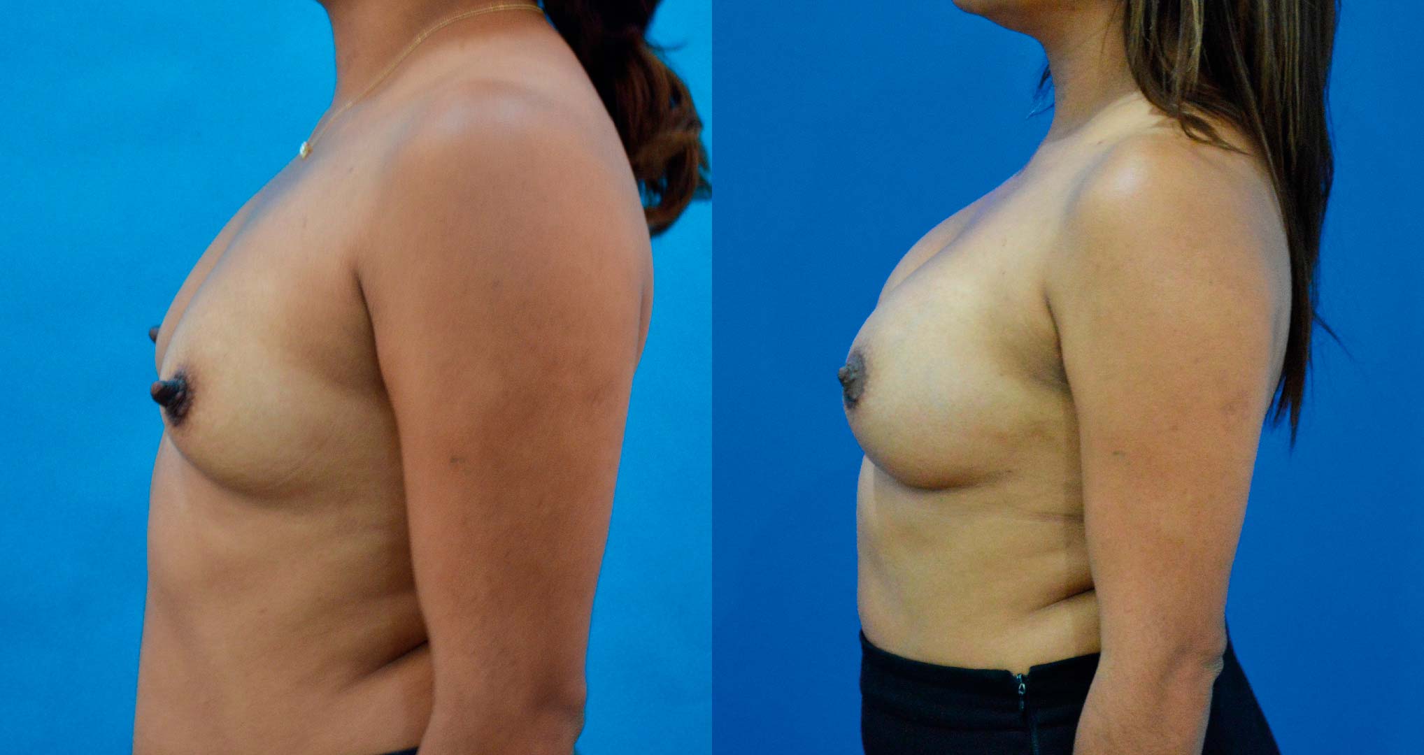 dr-valdez-breast-augmentation-_five