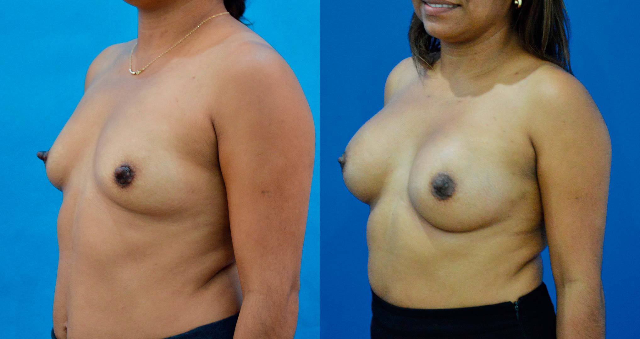 dr-valdez-breast-augmentation-_four