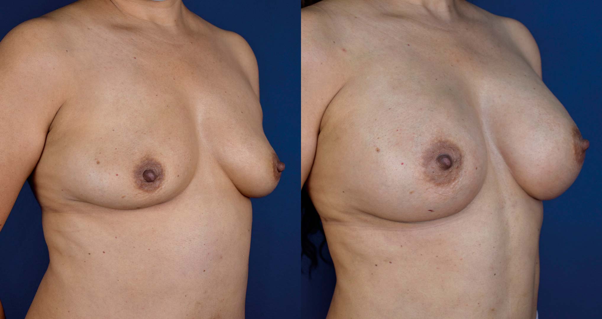 dr-valdez-breast-augmentation-_fourteen