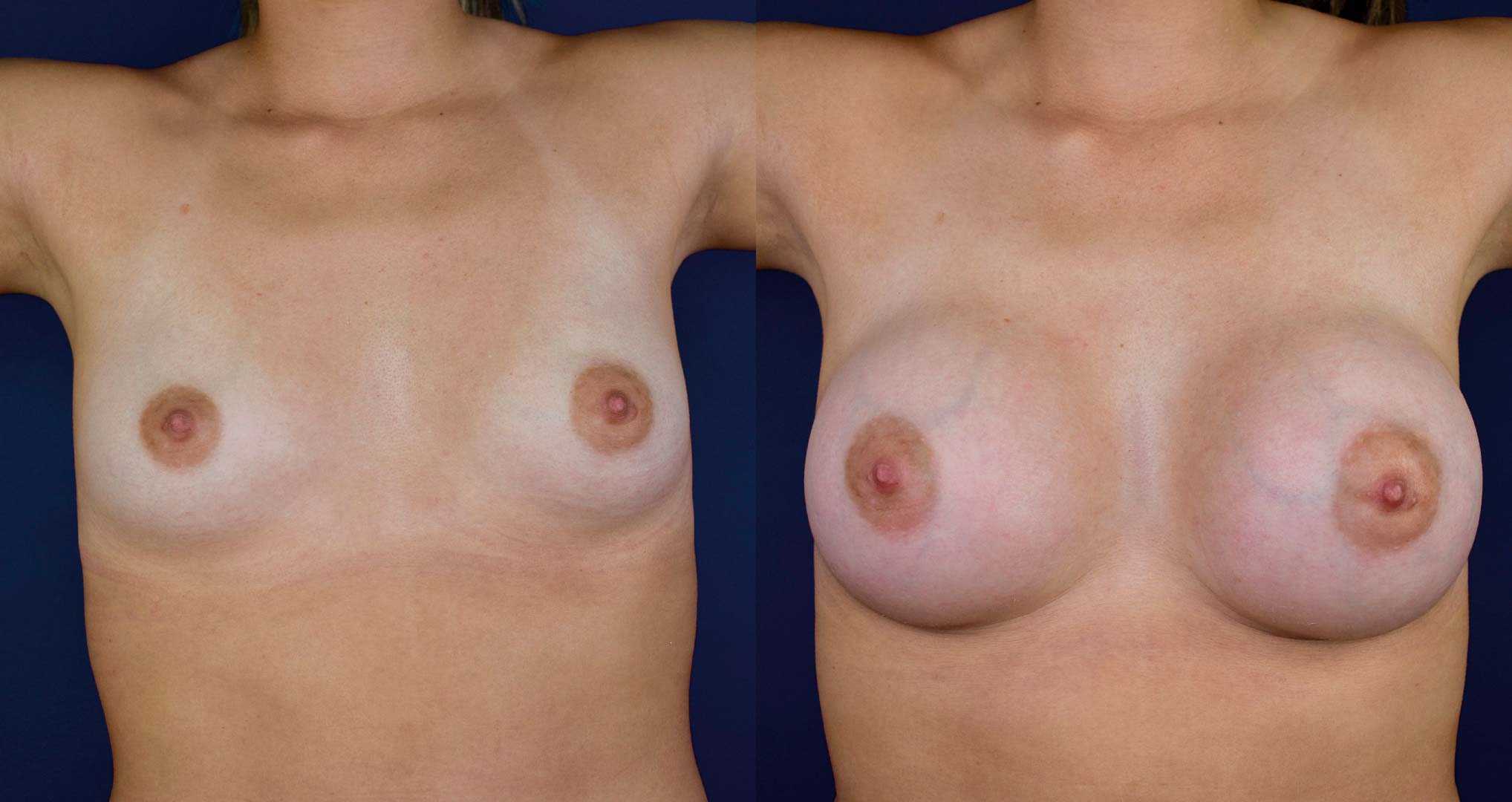 dr-valdez-breast-augmentation-_nine