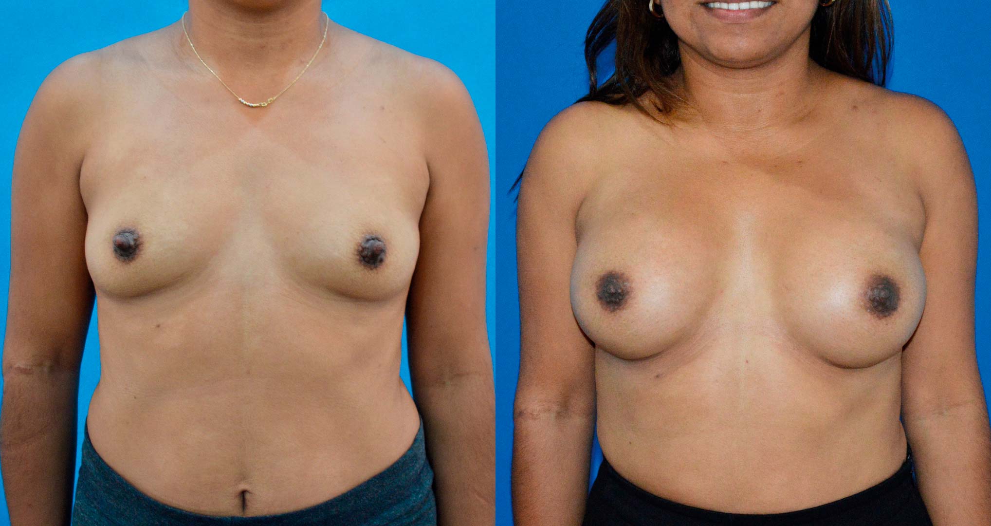 dr-valdez-breast-augmentation-_one