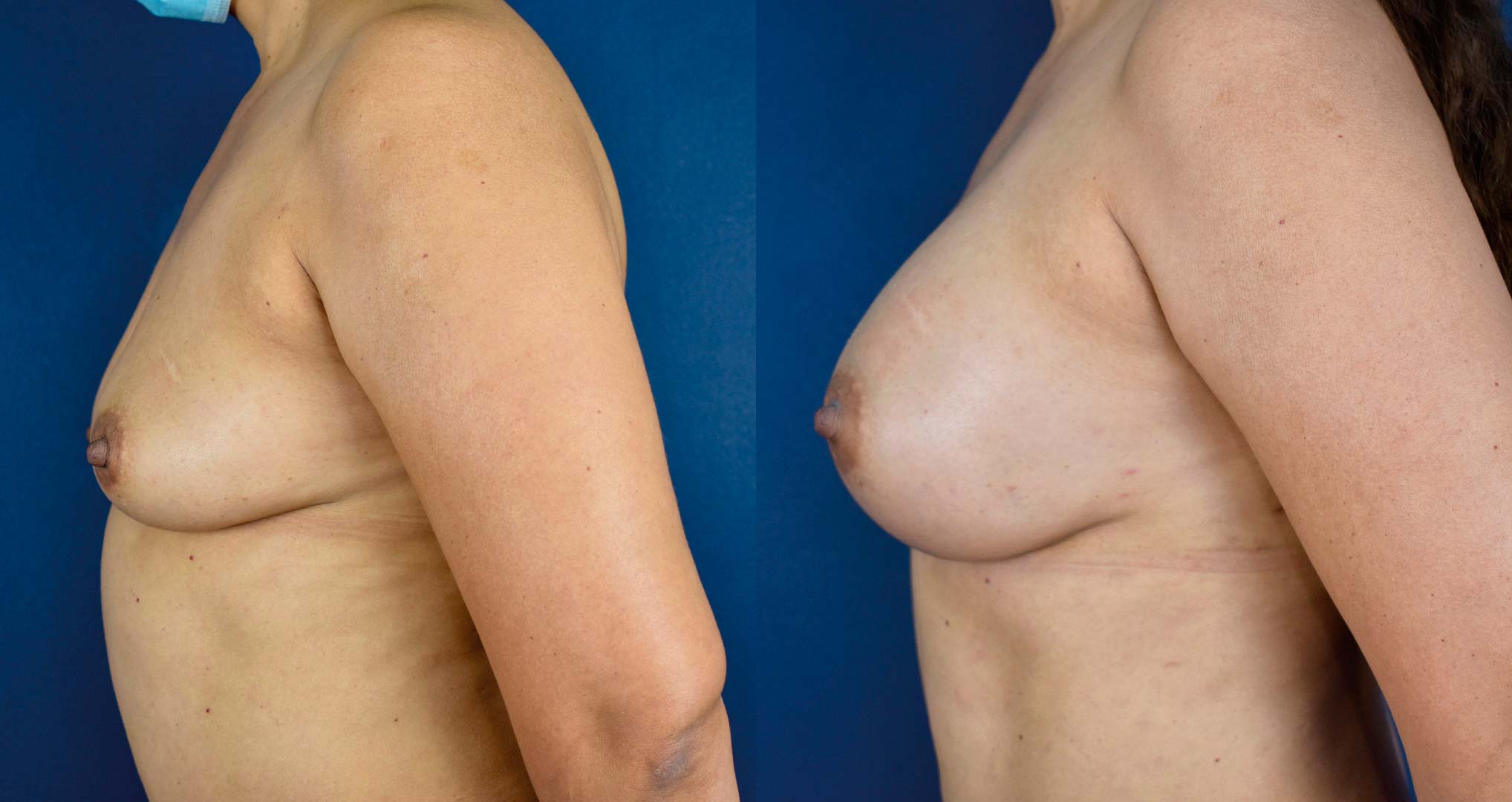 dr-valdez-breast-augmentation-_seventeen