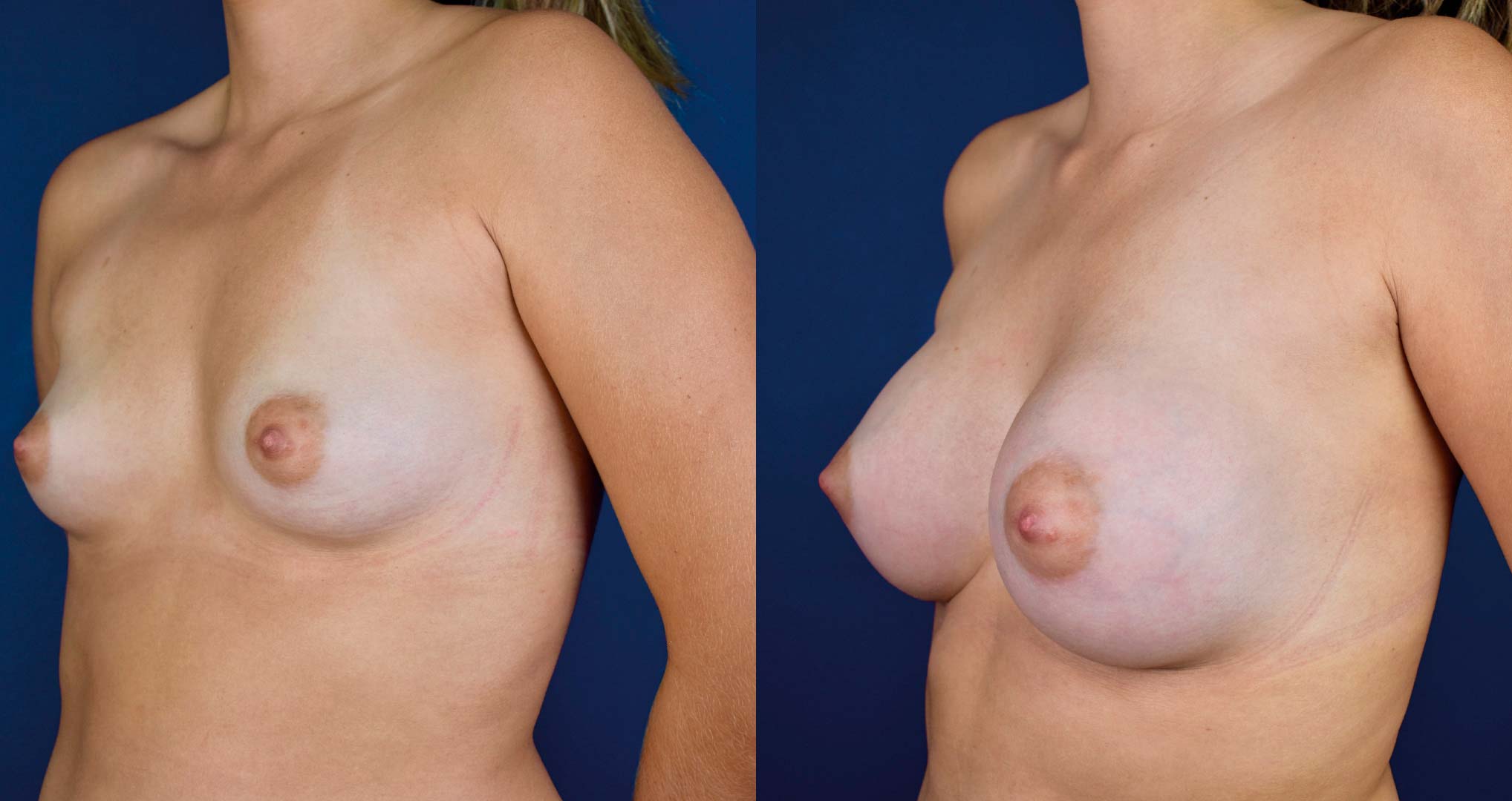 dr-valdez-breast-augmentation-_six