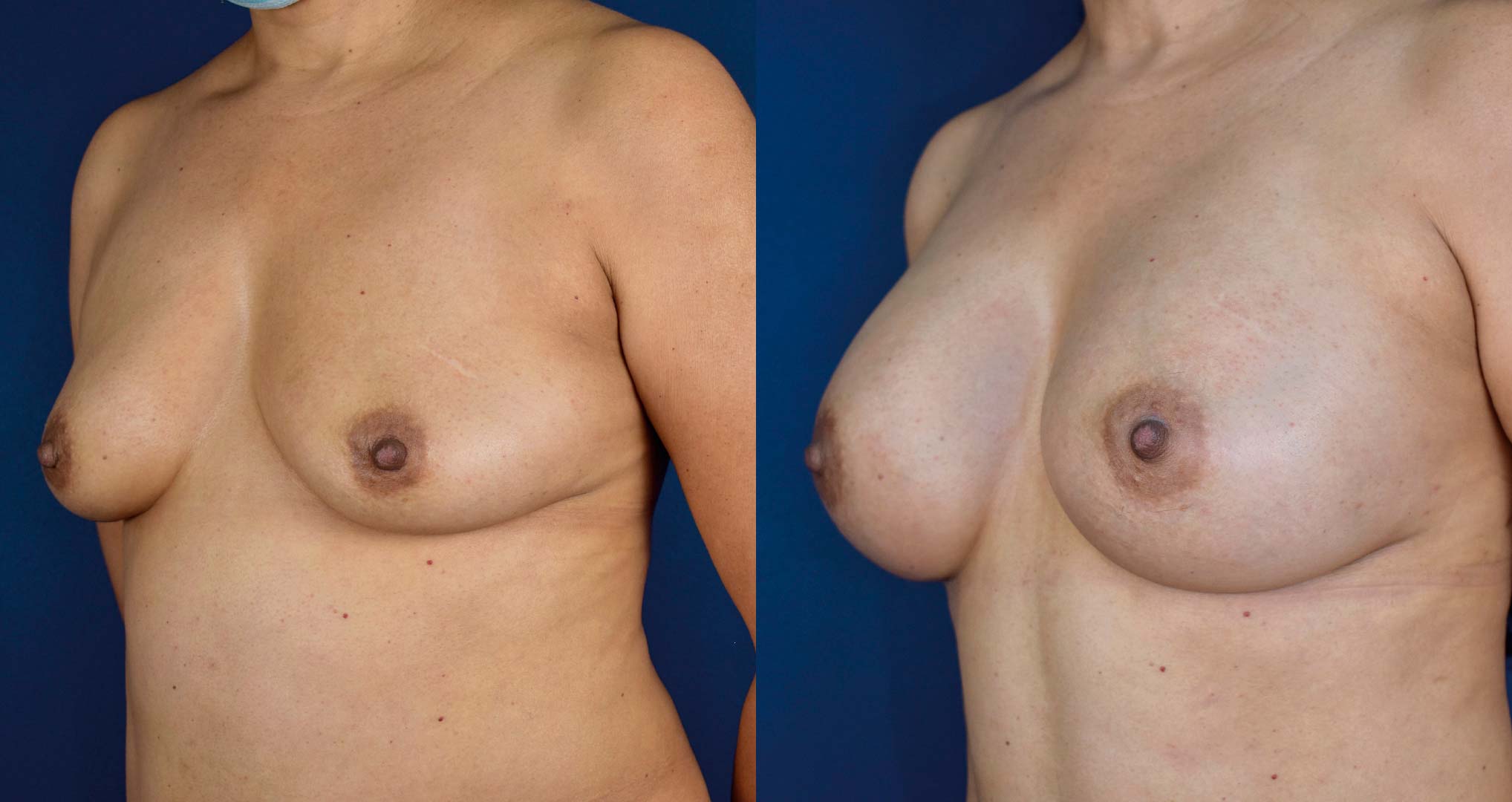 dr-valdez-breast-augmentation-_sixteen