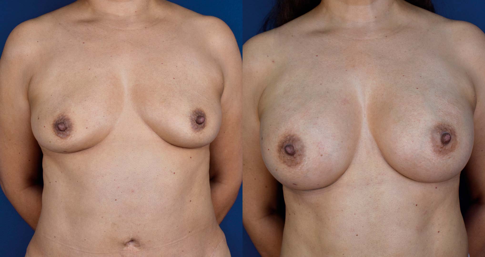 dr-valdez-breast-augmentation-_thirteen