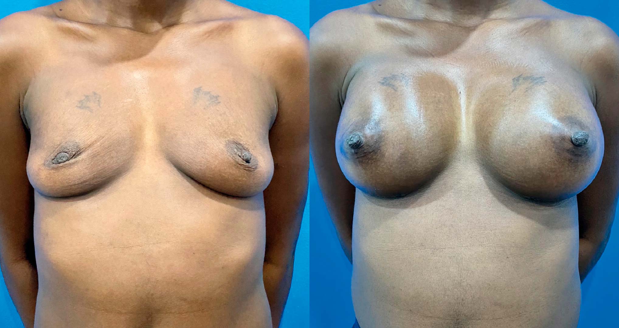 dr-valdez-breast-augmentation-_thirty