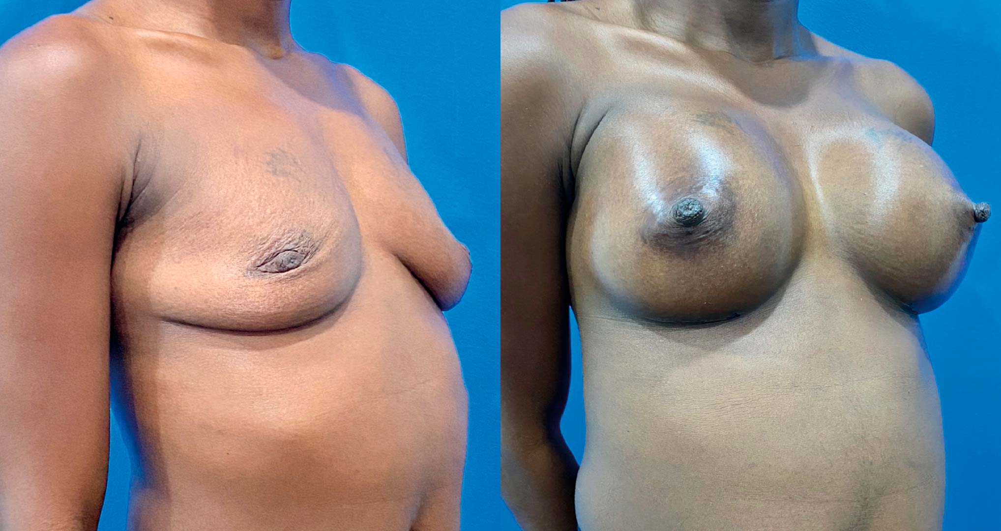 dr-valdez-breast-augmentation-_thirtyone