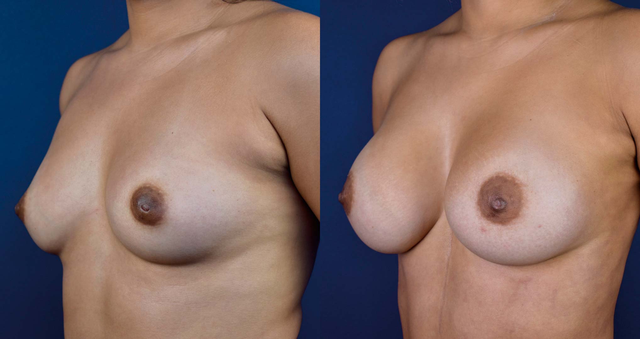 dr-valdez-breast-augmentation-_thirtysix