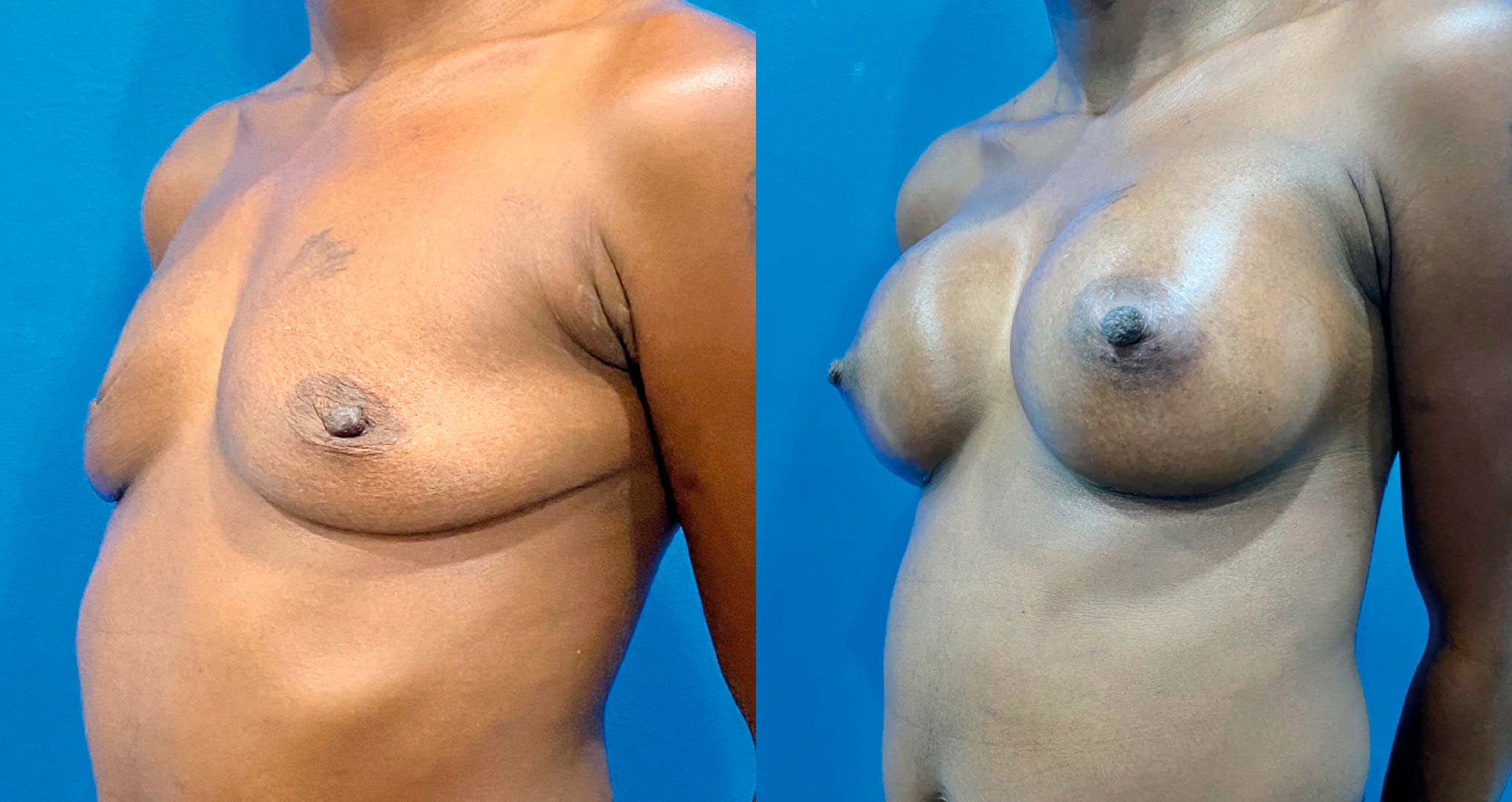 dr-valdez-breast-augmentation-_thirtytwo