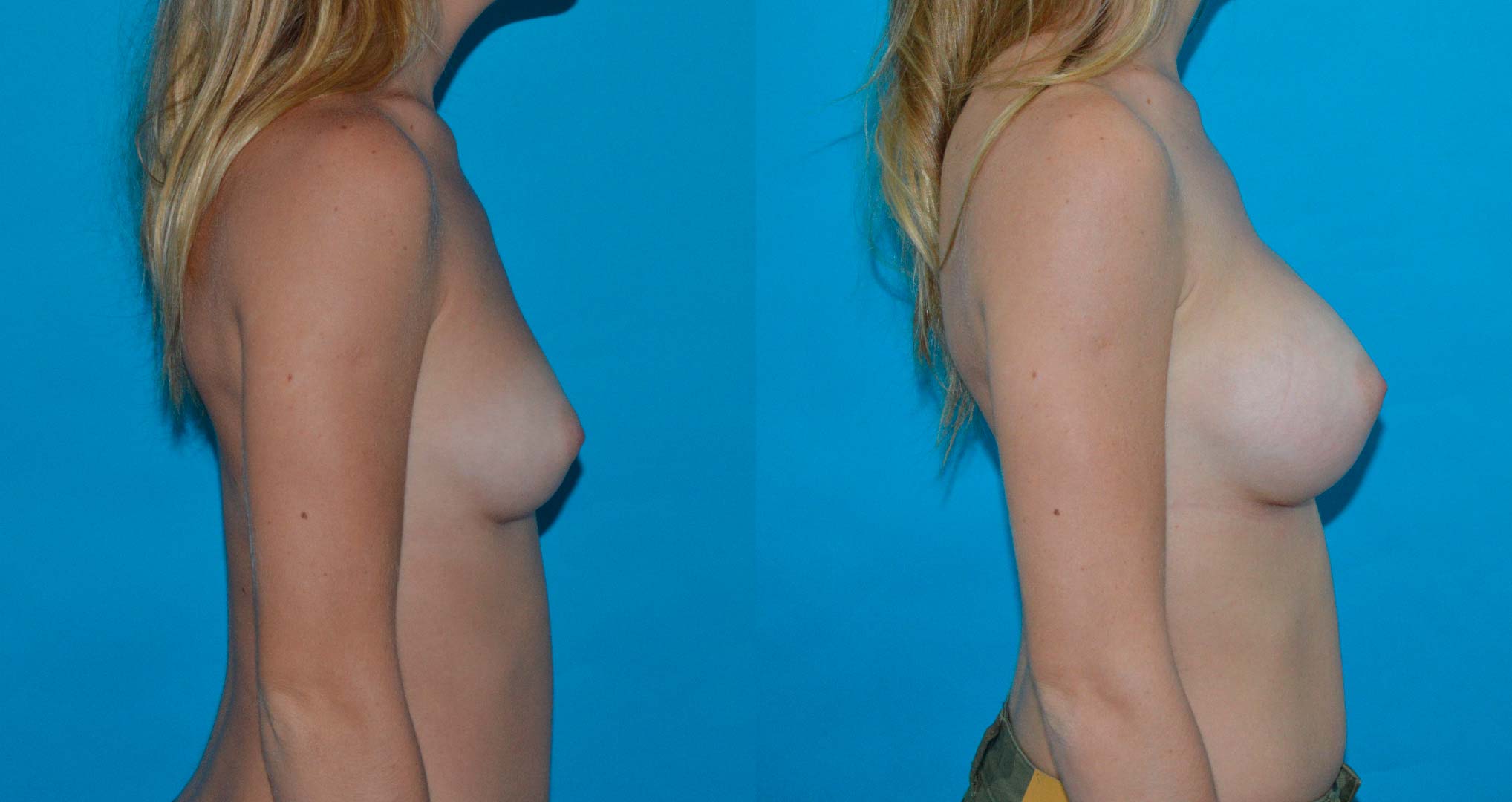 dr-valdez-breast-augmentation-_twenty