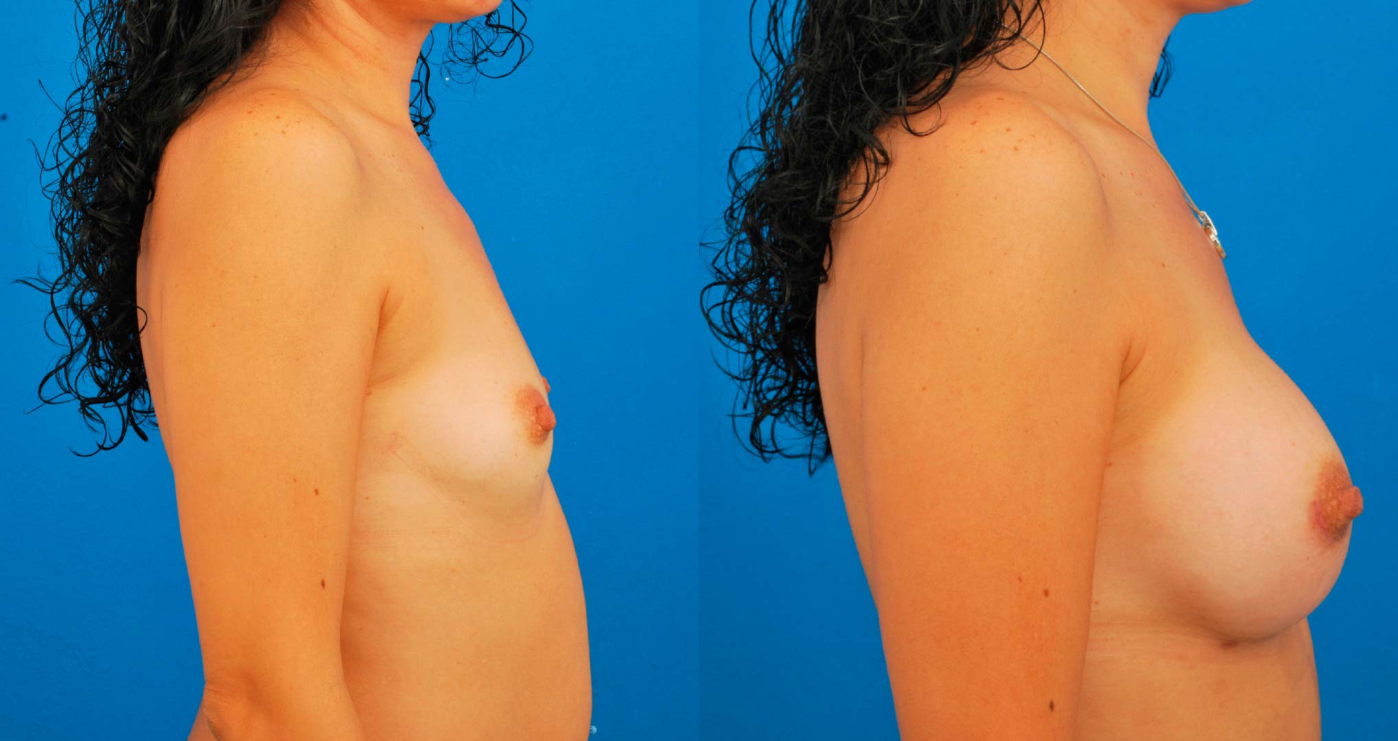 dr-valdez-breast-augmentation-_twentyfive