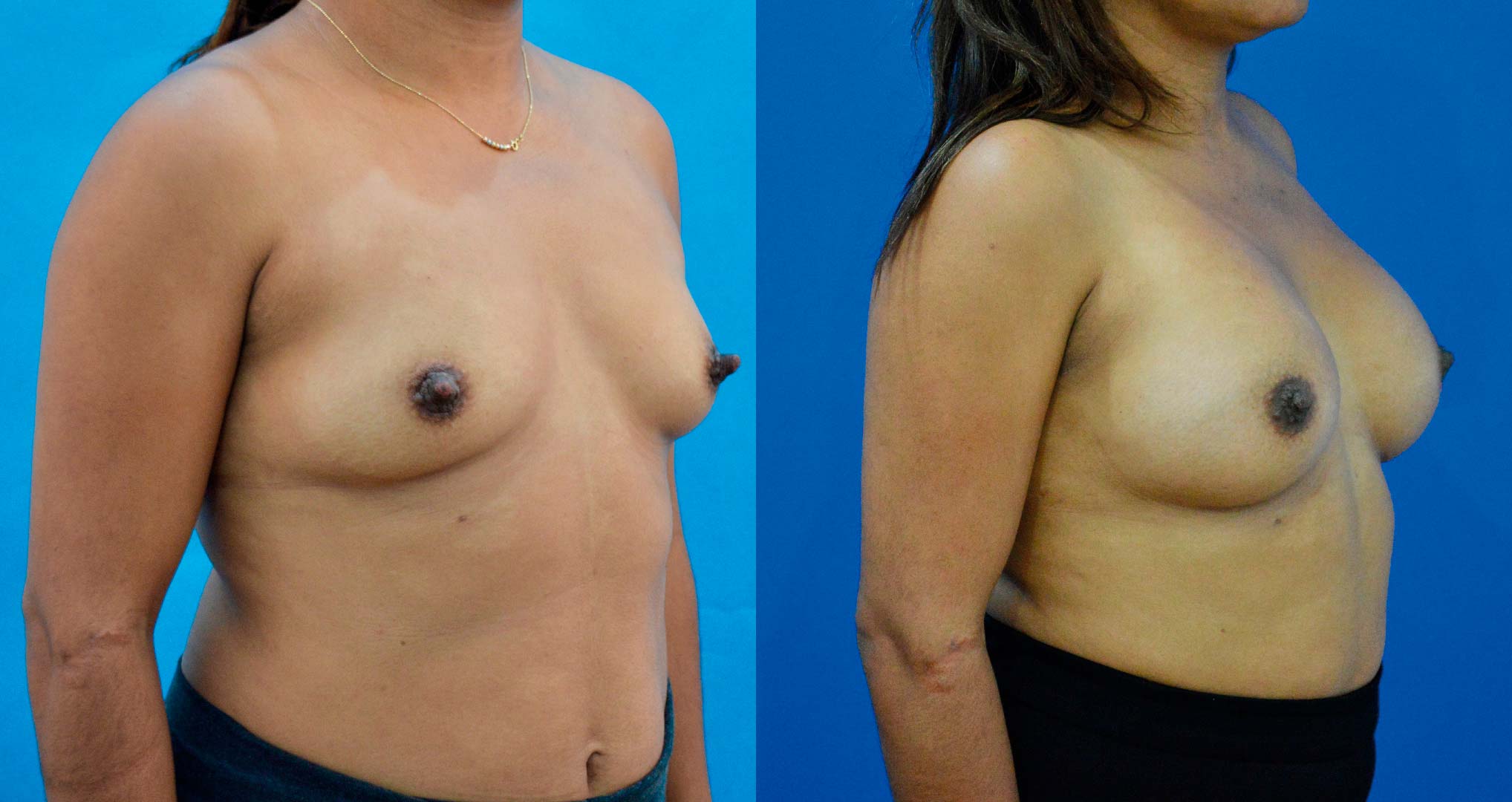 dr-valdez-breast-augmentation-_two