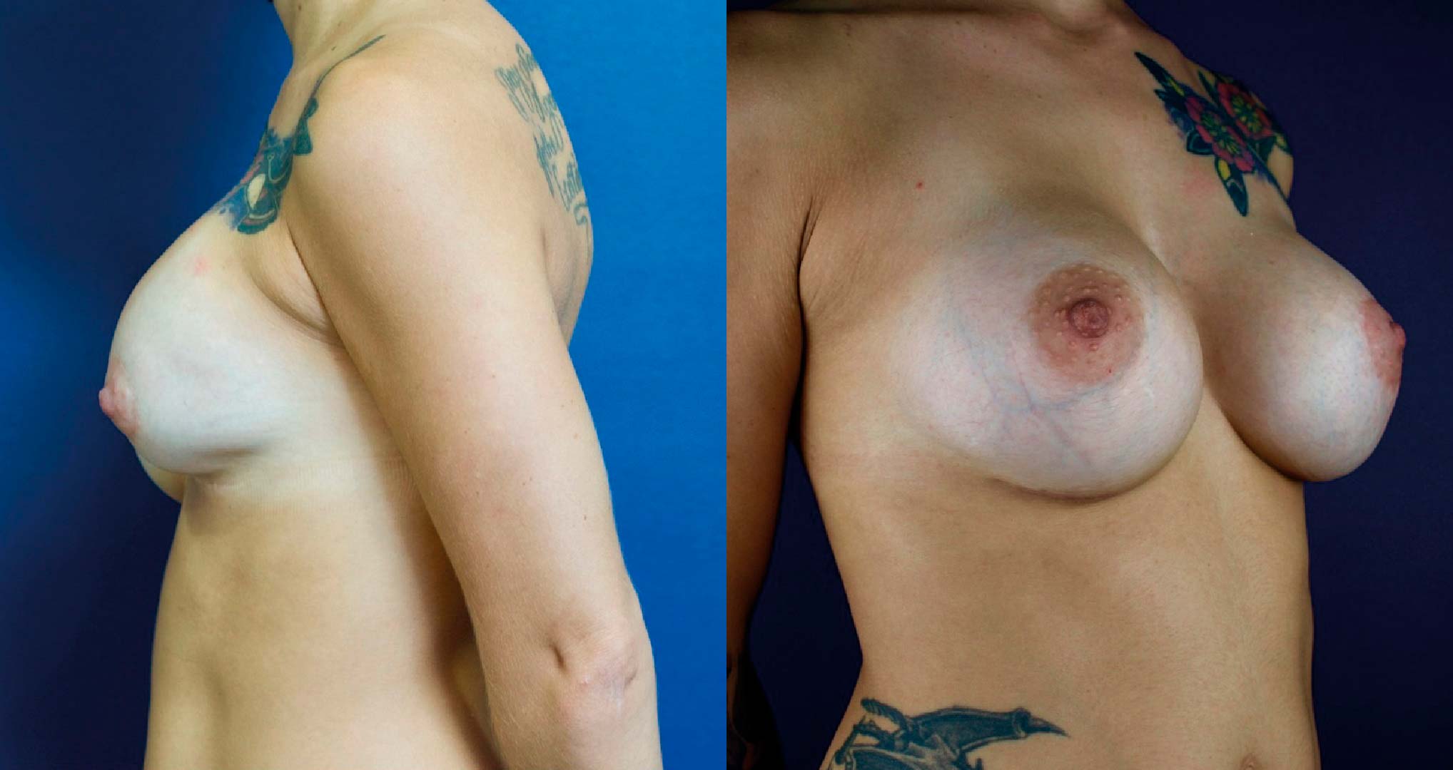 dr-valdez-breast-implant-revision__nineteen