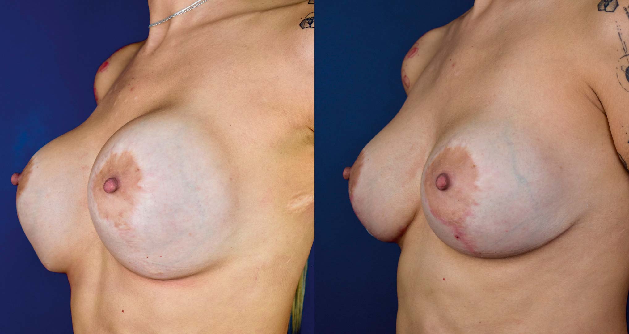 dr-valdez-breast-implant-revision_thirteen