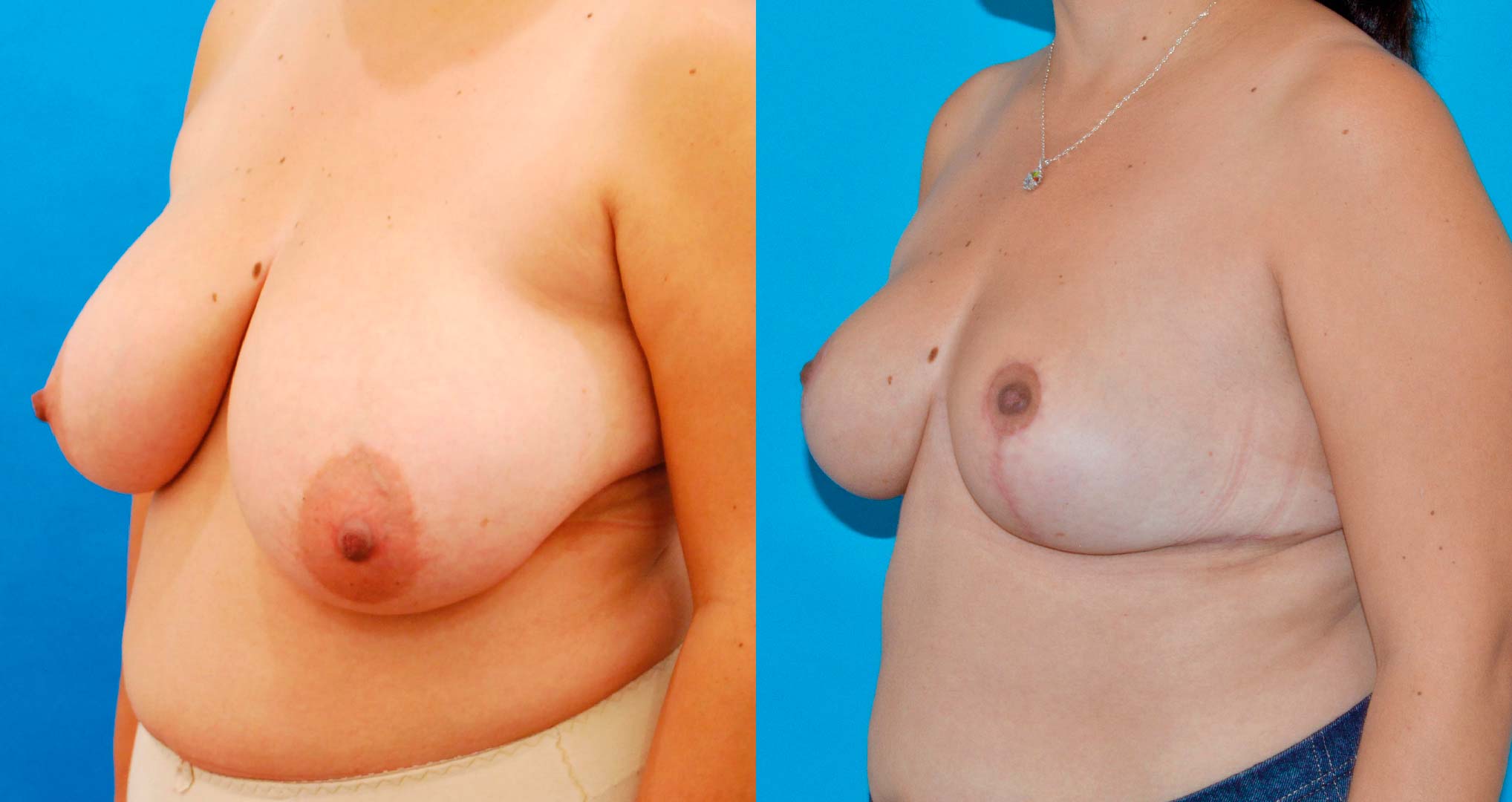 dr-valdez-breast-reduction_fifteen