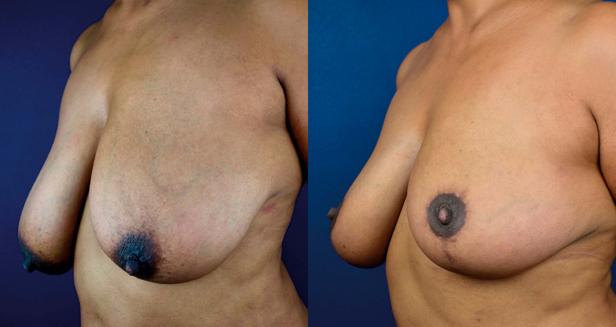 dr-valdez-breast-reduction_four