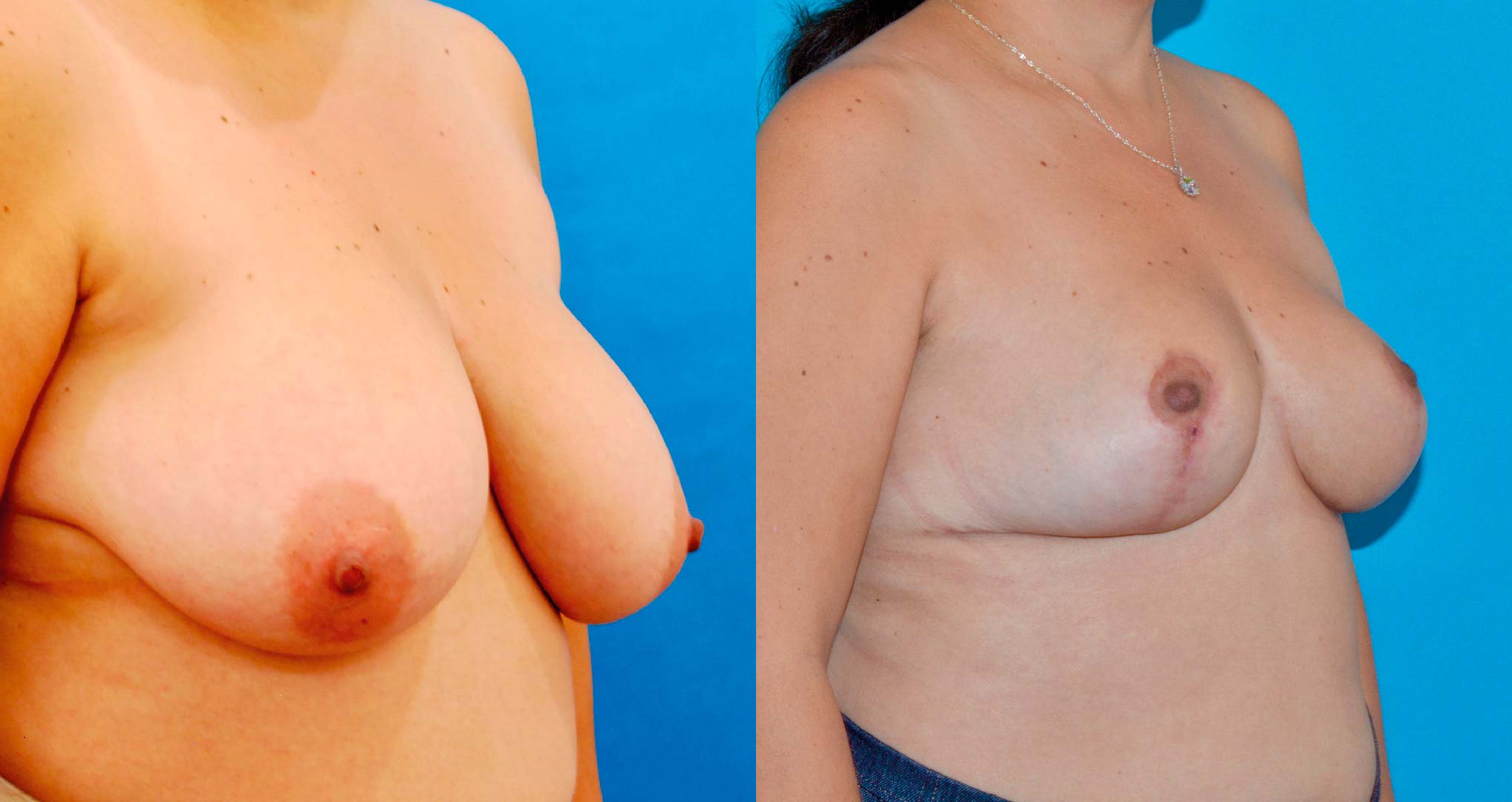 dr-valdez-breast-reduction_fourteen