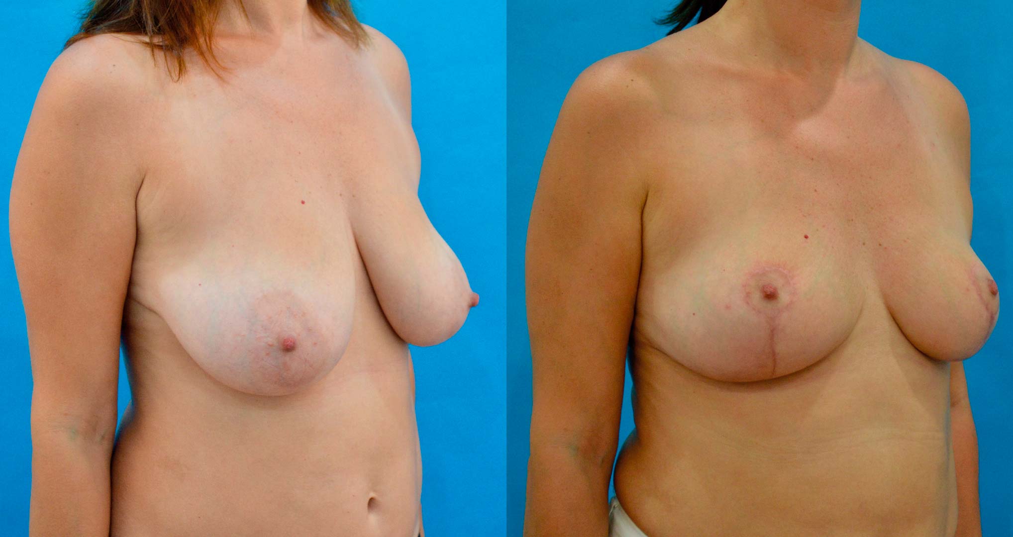 dr-valdez-breast-reduction_seven