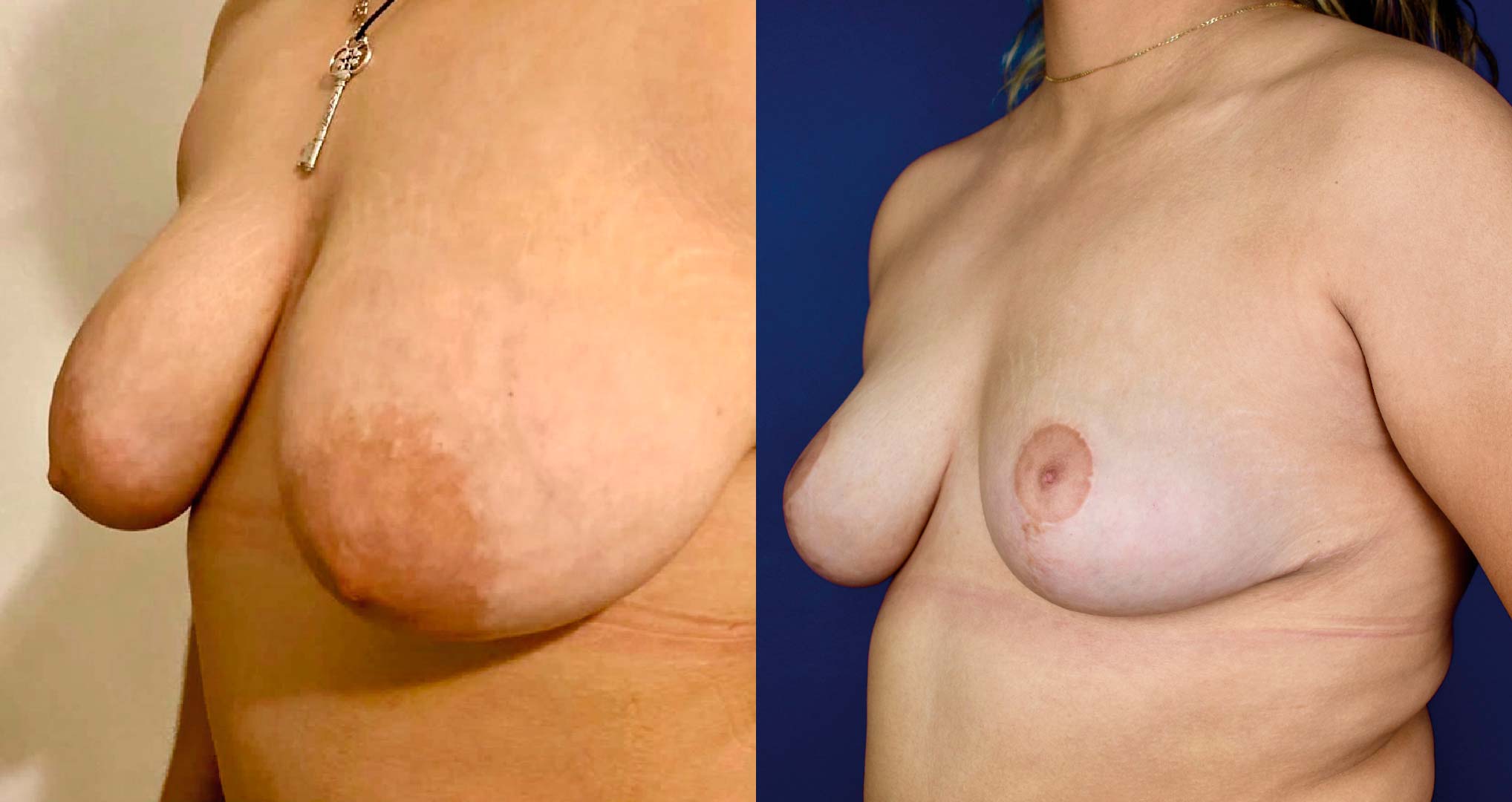 dr-valdez-breast-reduction_seventeen