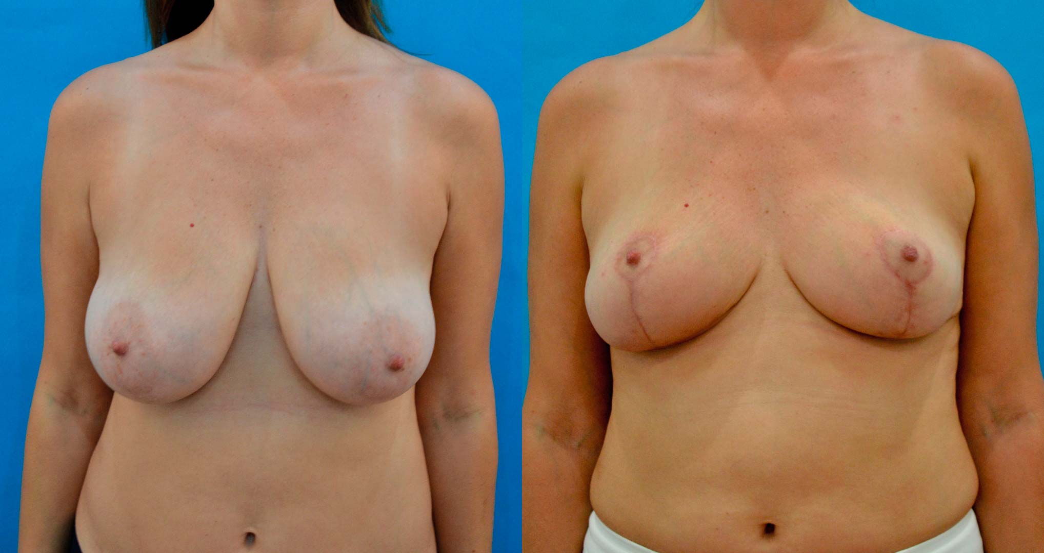 dr-valdez-breast-reduction_six