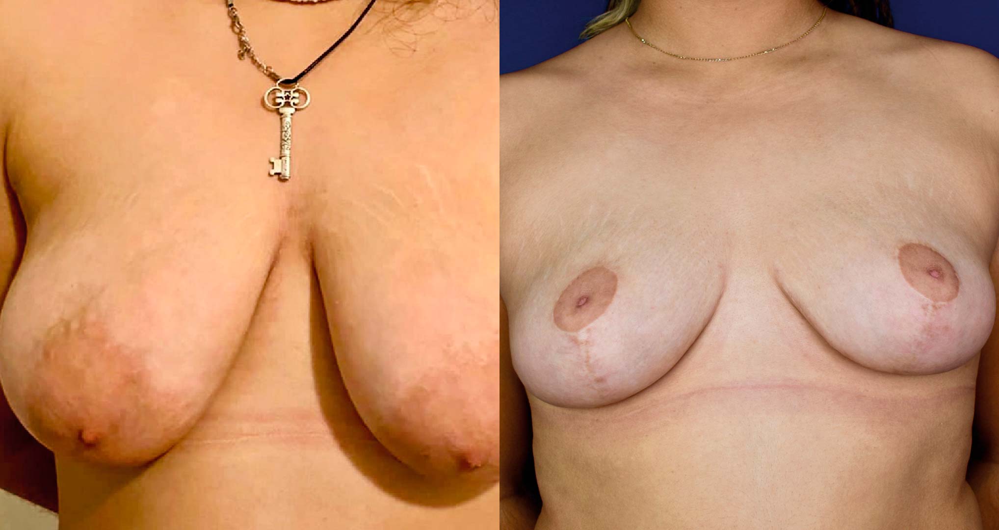 dr-valdez-breast-reduction_sixteen