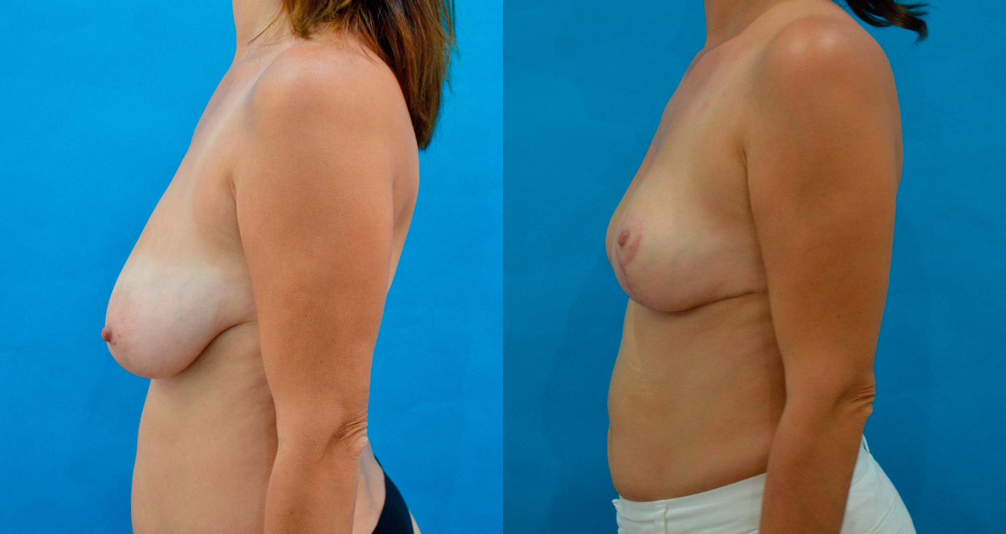 dr-valdez-breast-reduction_ten