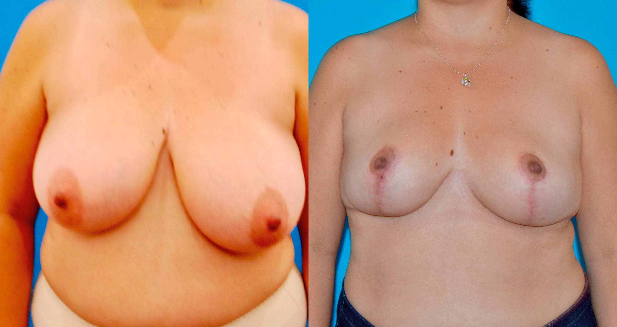 dr-valdez-breast-reduction_thirteen