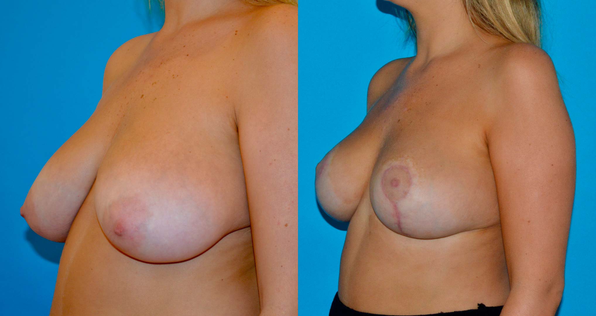 dr-valdez-breast-reduction_twentyone