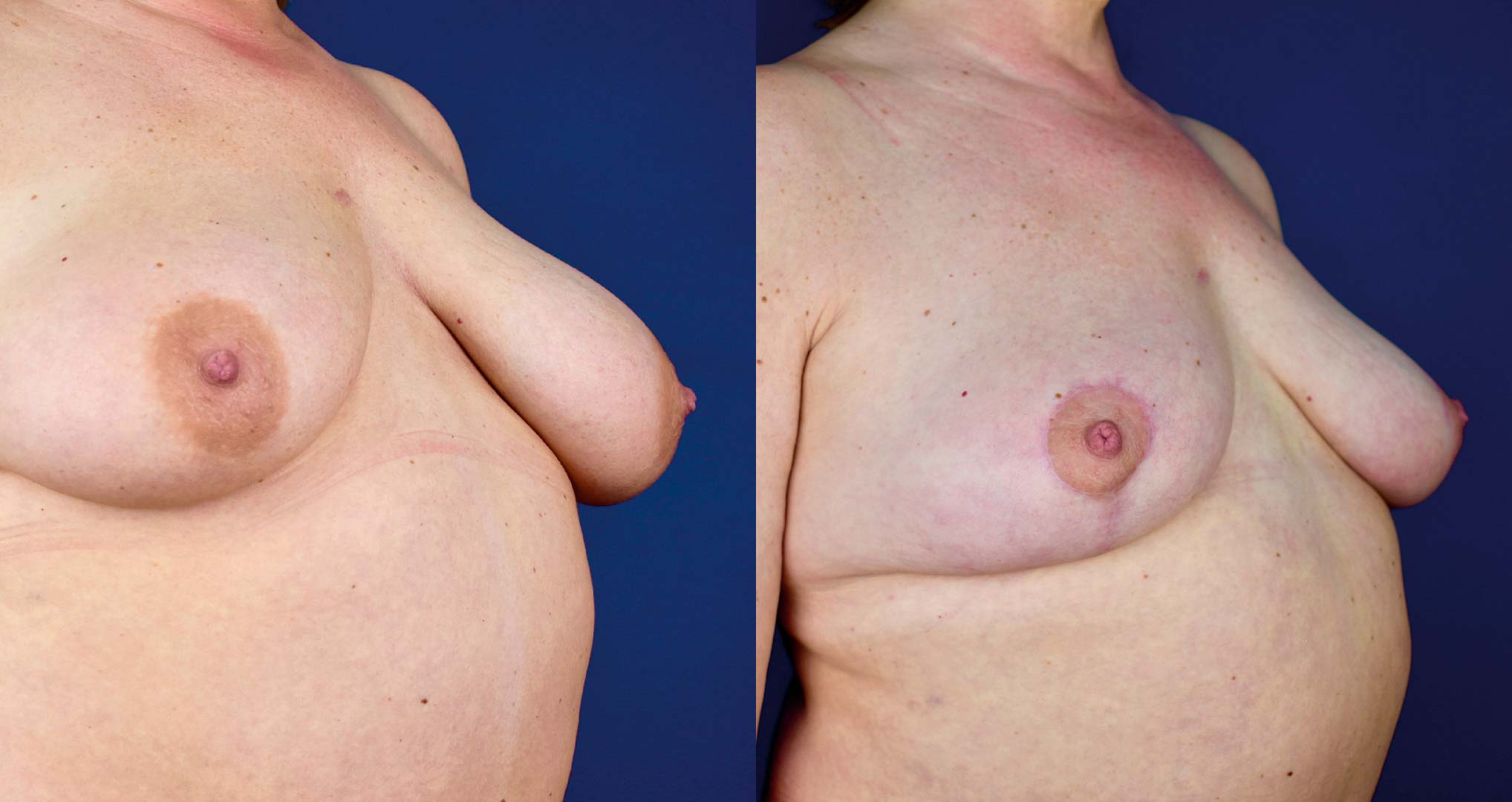 dr-valdez-breast-reduction_twentyseven