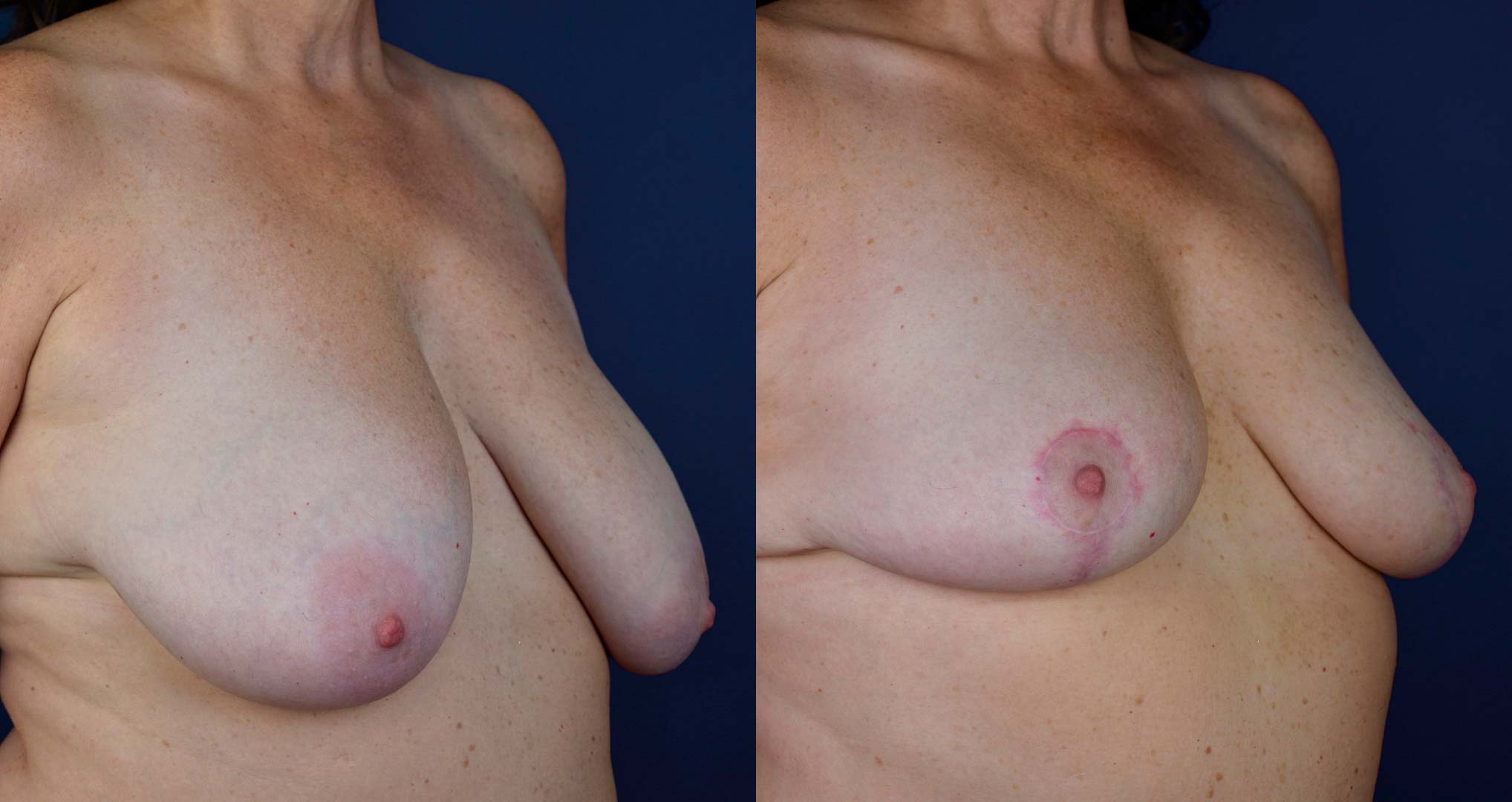 dr-valdez-breast-reduction_twentysix