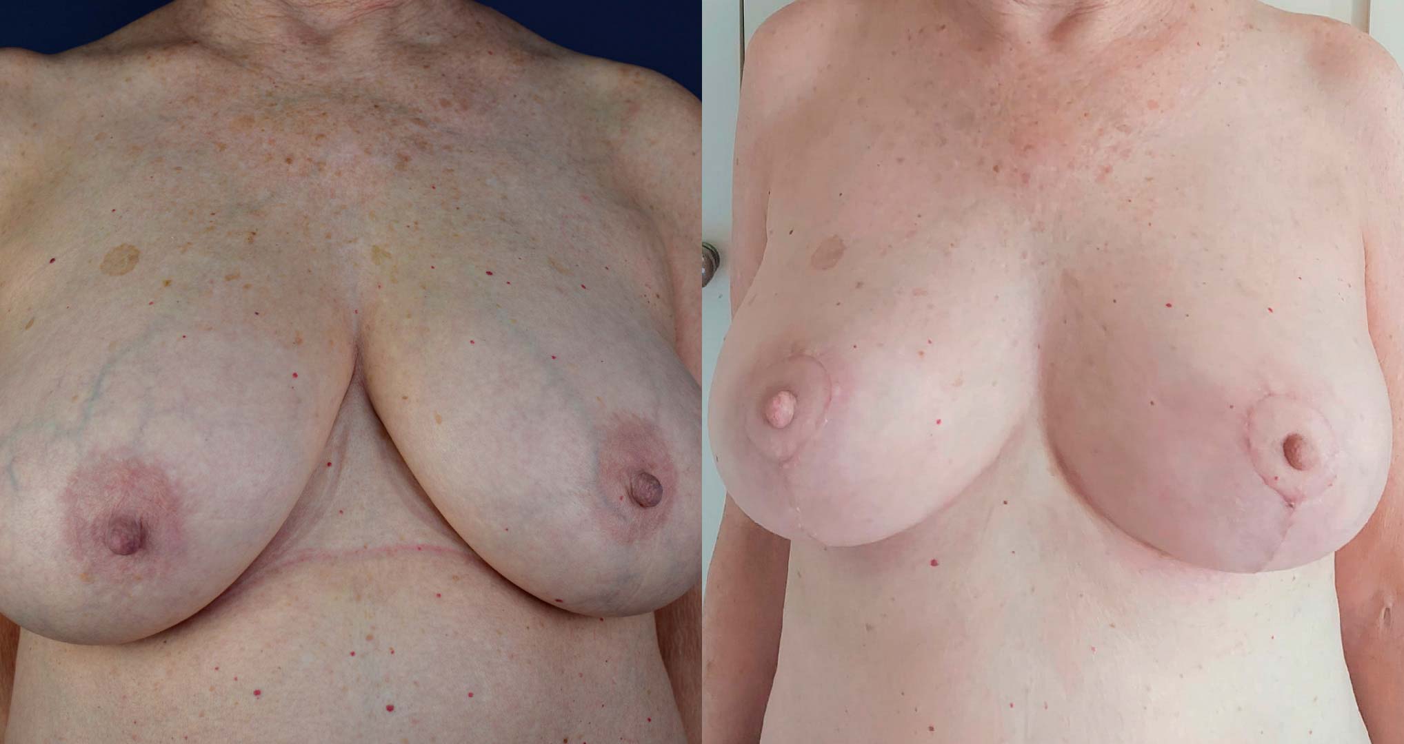 dr-valdez-breast-reduction_twentytwo