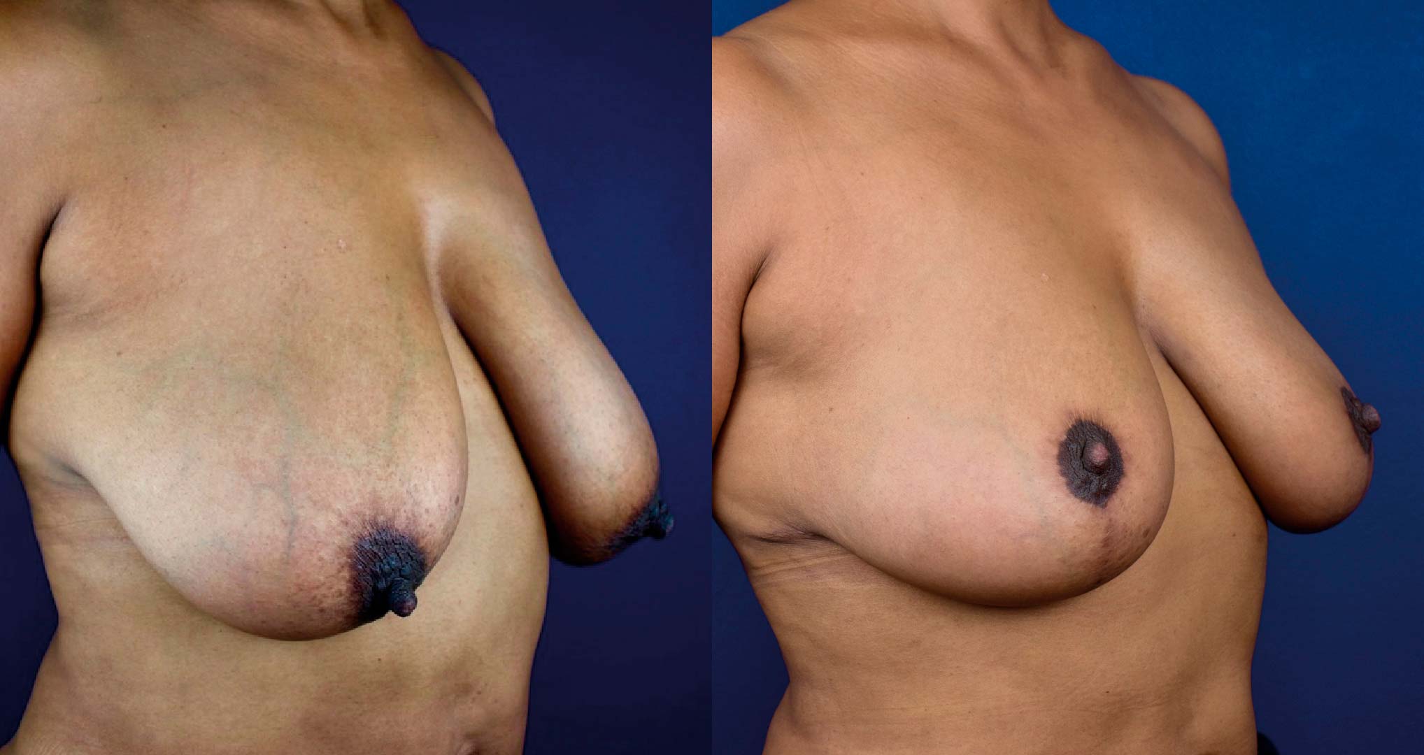 dr-valdez-breast-reduction_two