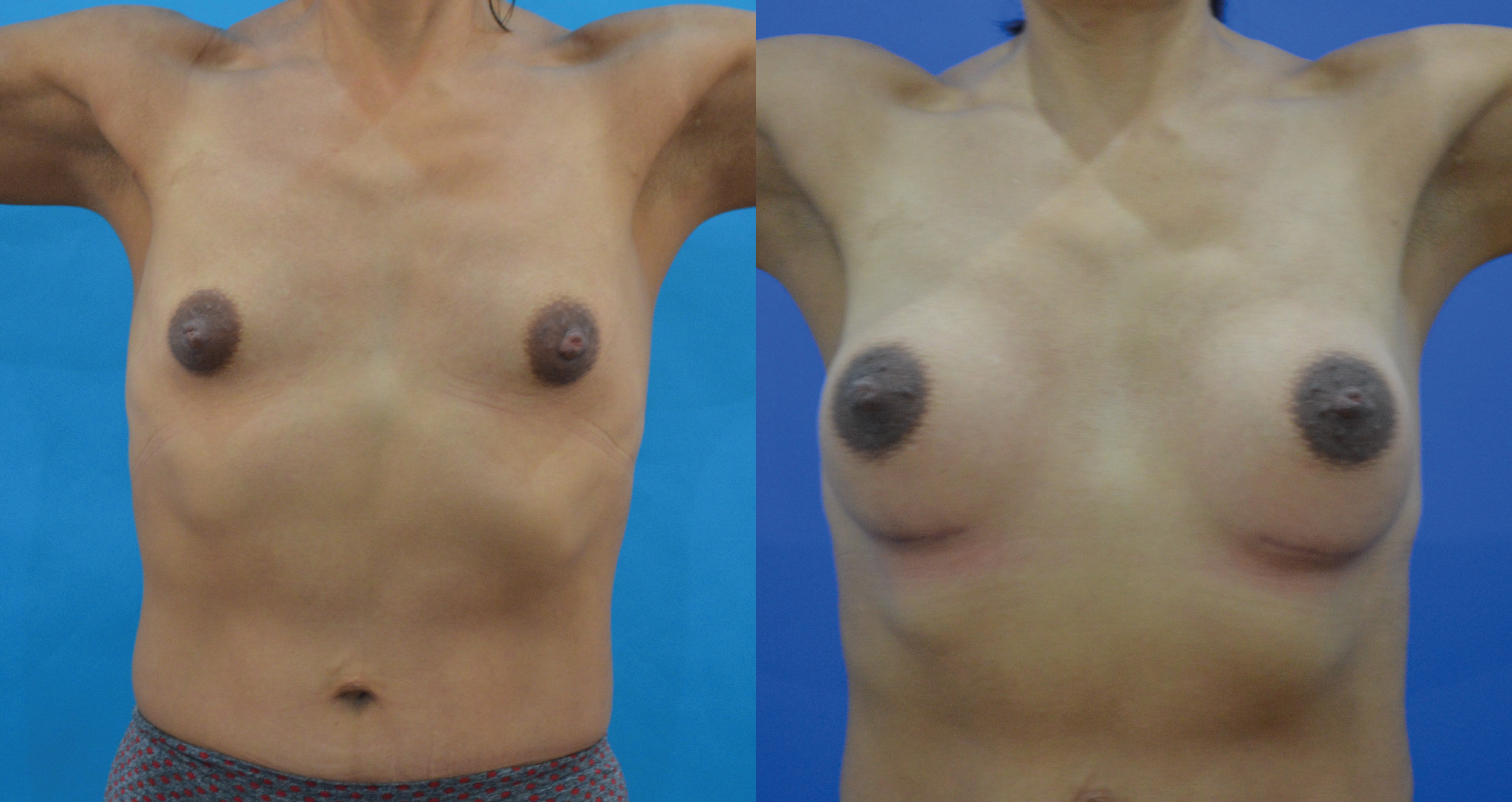 dr-valdez-reconstruction-of-tuberous-breast_eleven