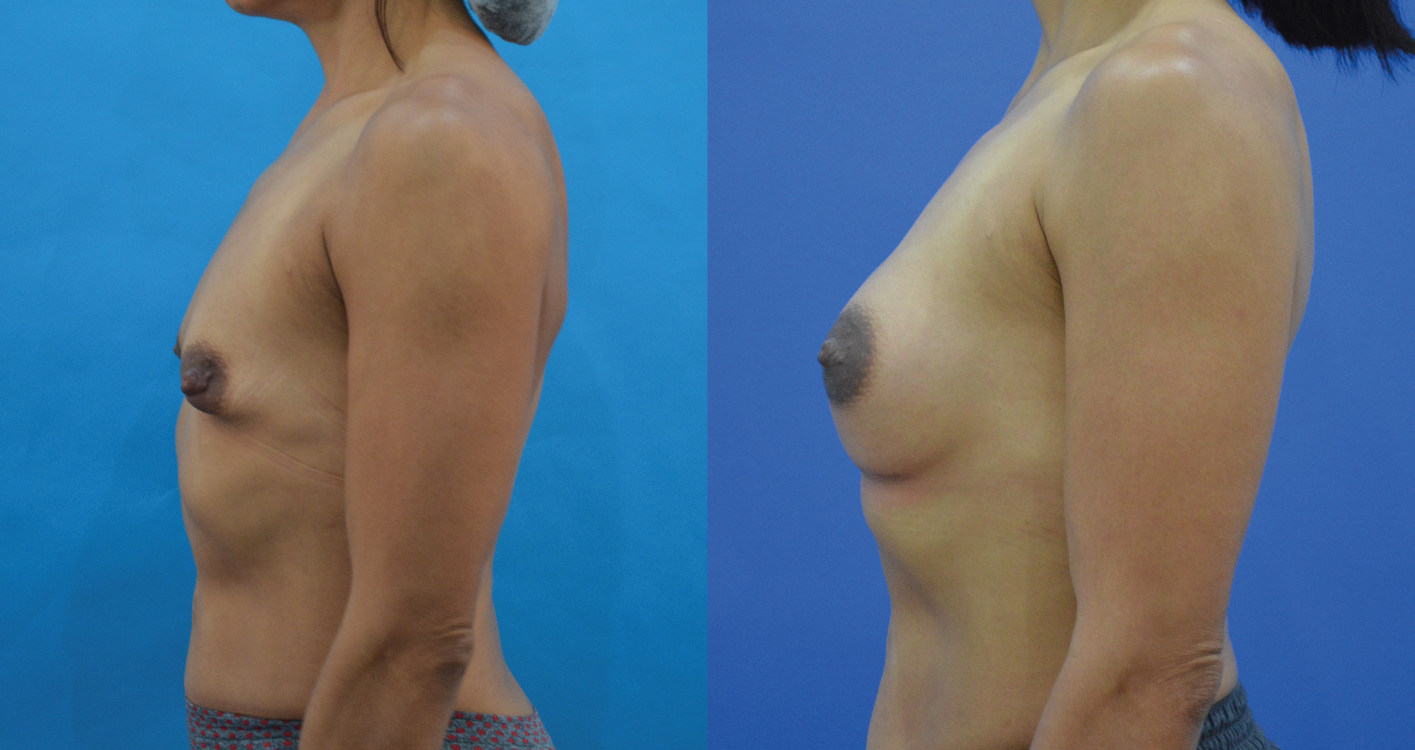 dr-valdez-reconstruction-of-tuberous-breast_fifteen