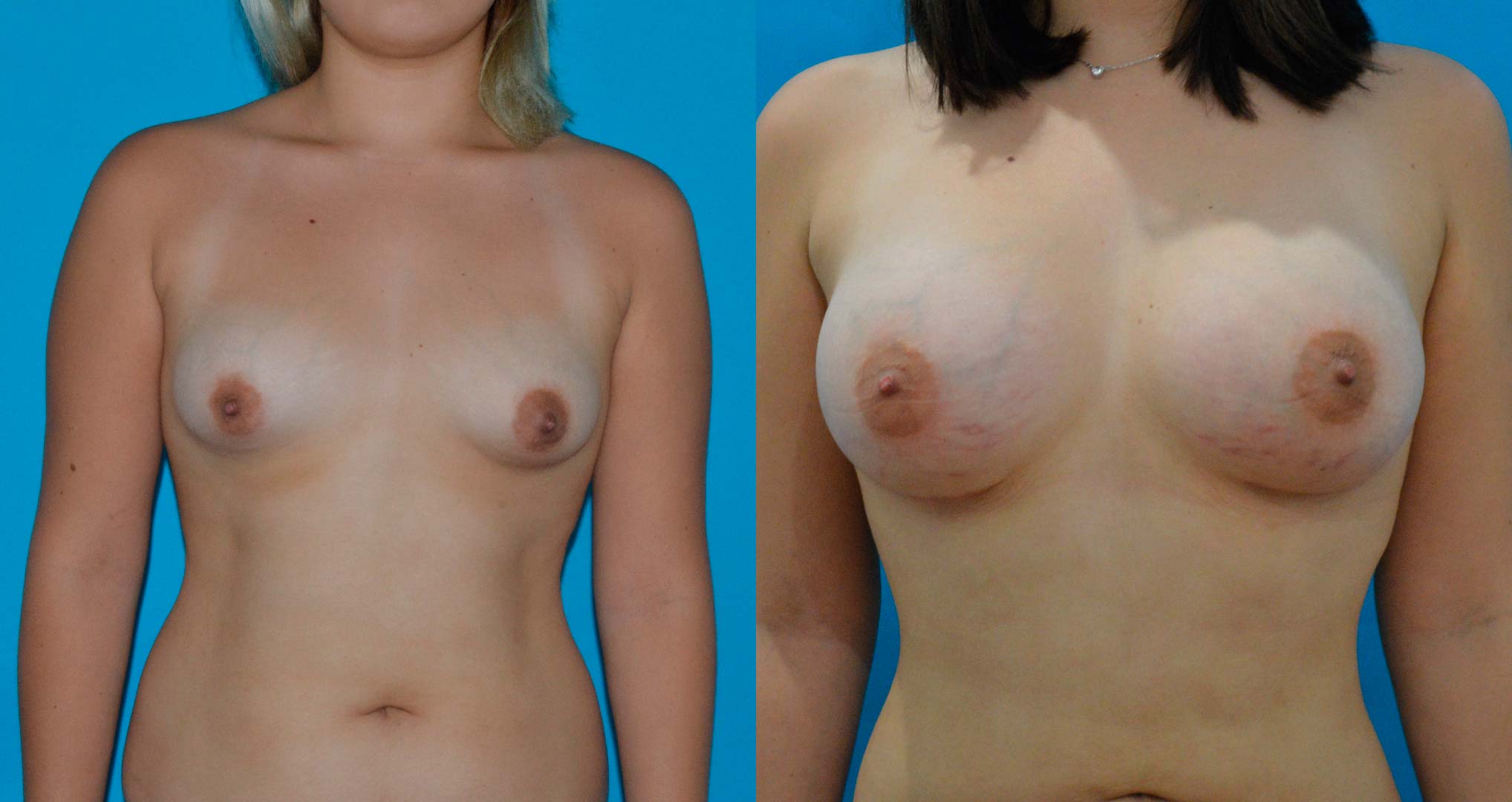 dr-valdez-reconstruction-of-tuberous-breast_five