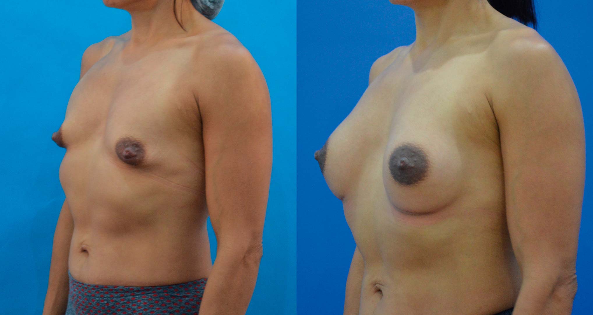 dr-valdez-reconstruction-of-tuberous-breast_fourteen