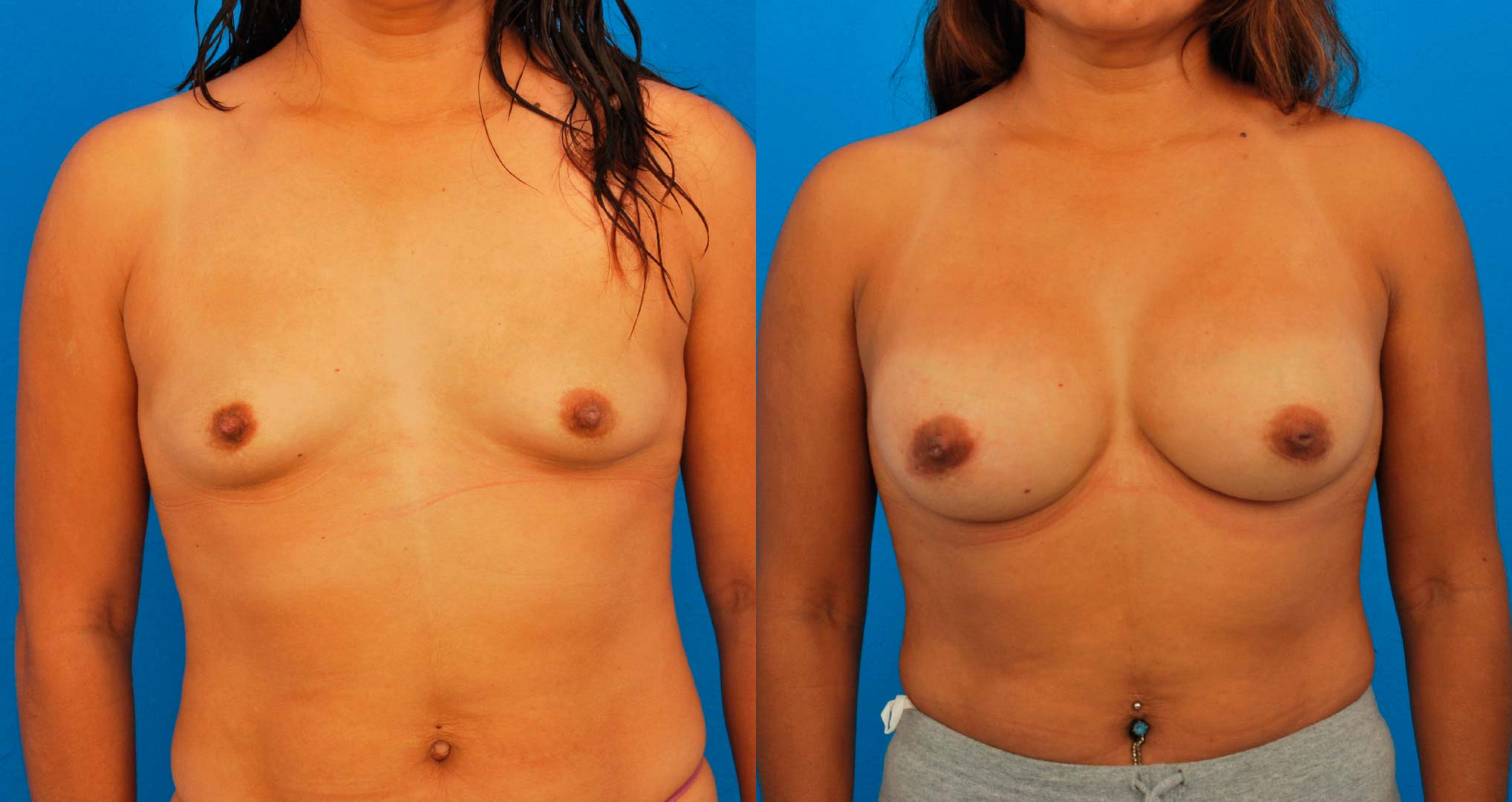 dr-valdez-reconstruction-of-tuberous-breast_one