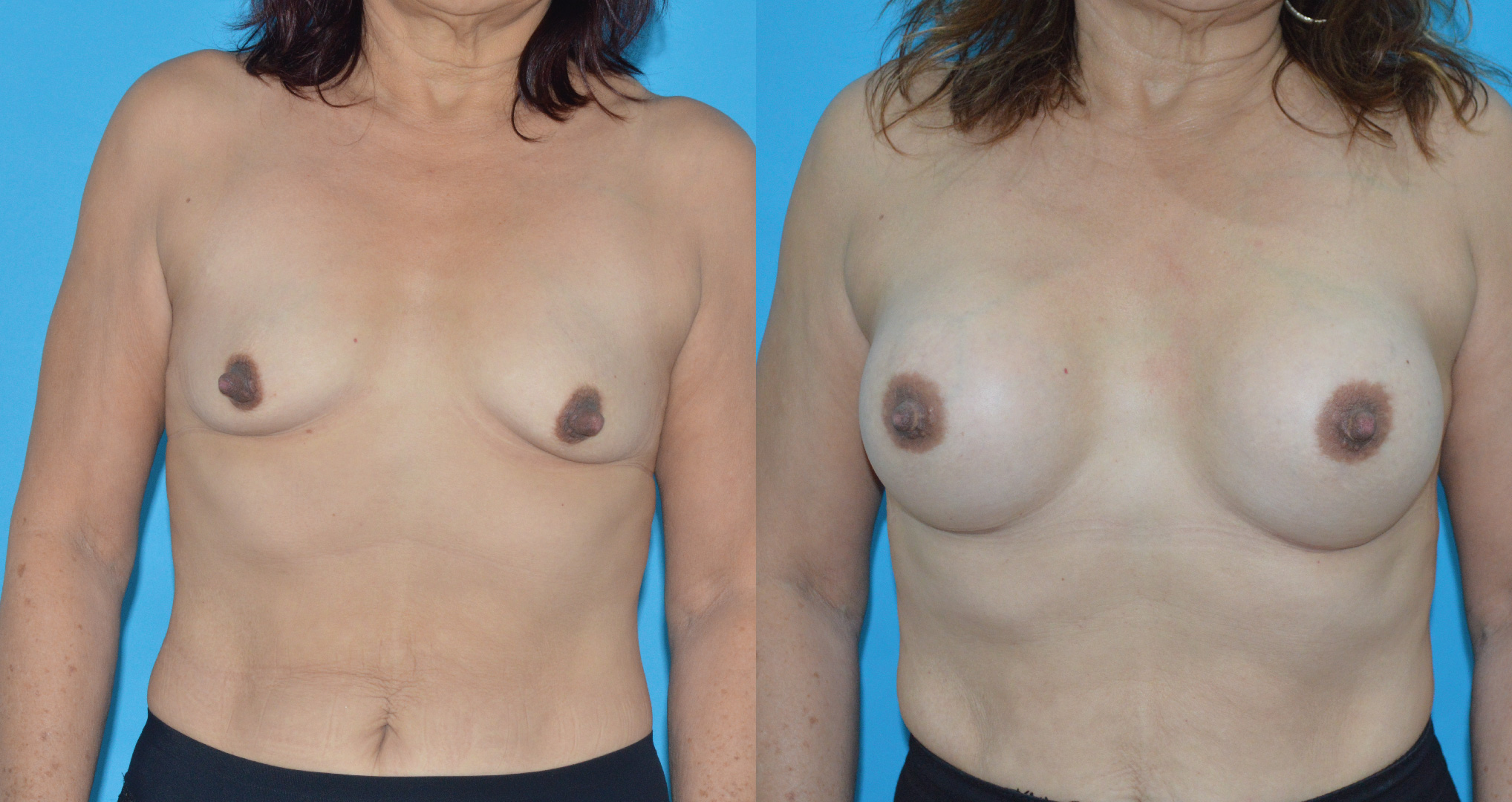 dr-valdez-reconstruction-of-tuberous-breast_sixteen