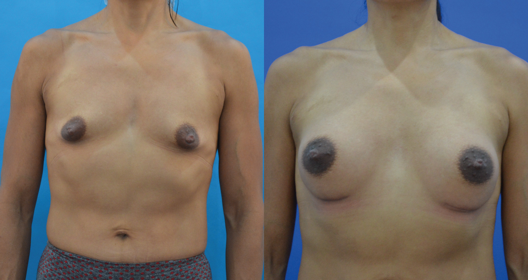 dr-valdez-reconstruction-of-tuberous-breast_ten