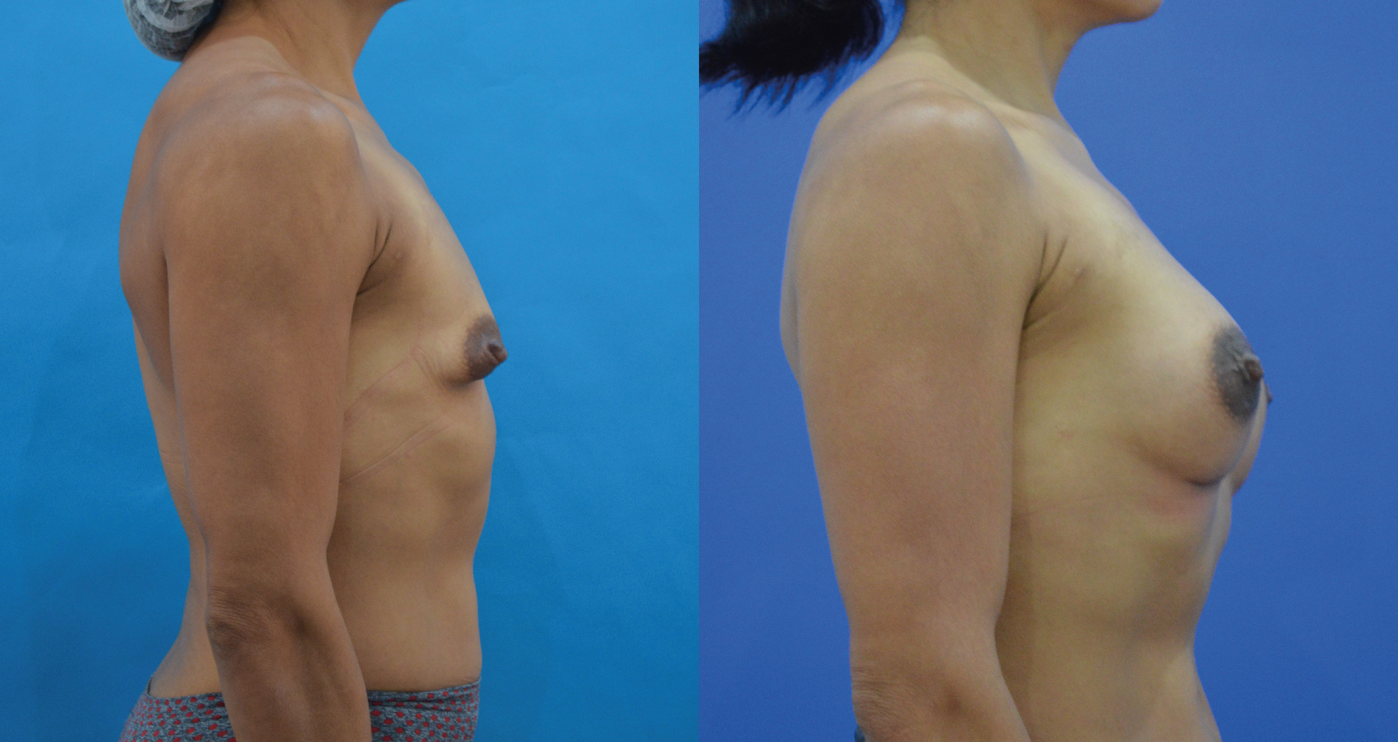 dr-valdez-reconstruction-of-tuberous-breast_thirteen